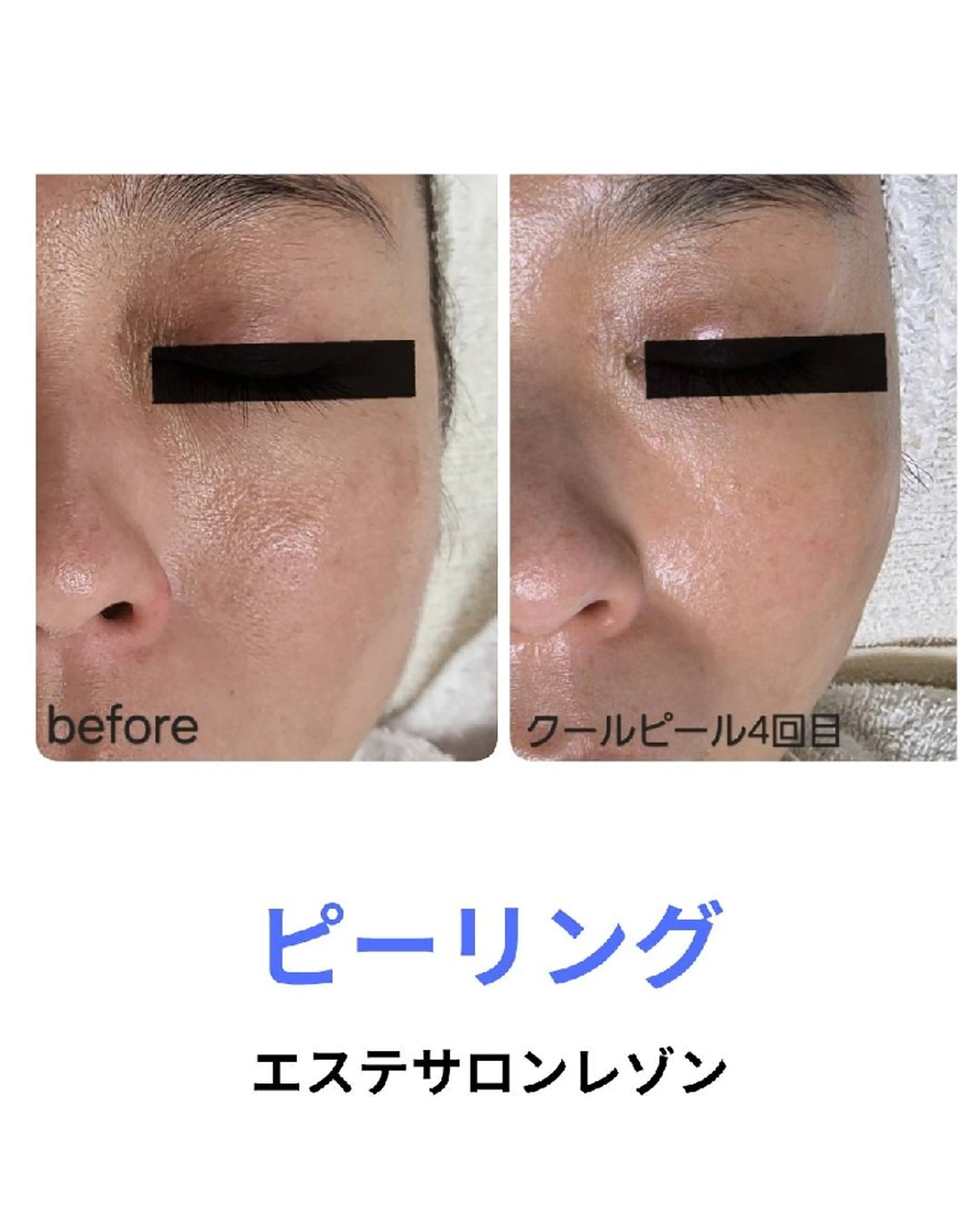 〈ニキビケアサロン〉 レゾン京橋店/ 浅川のエステ・リラクイメージ