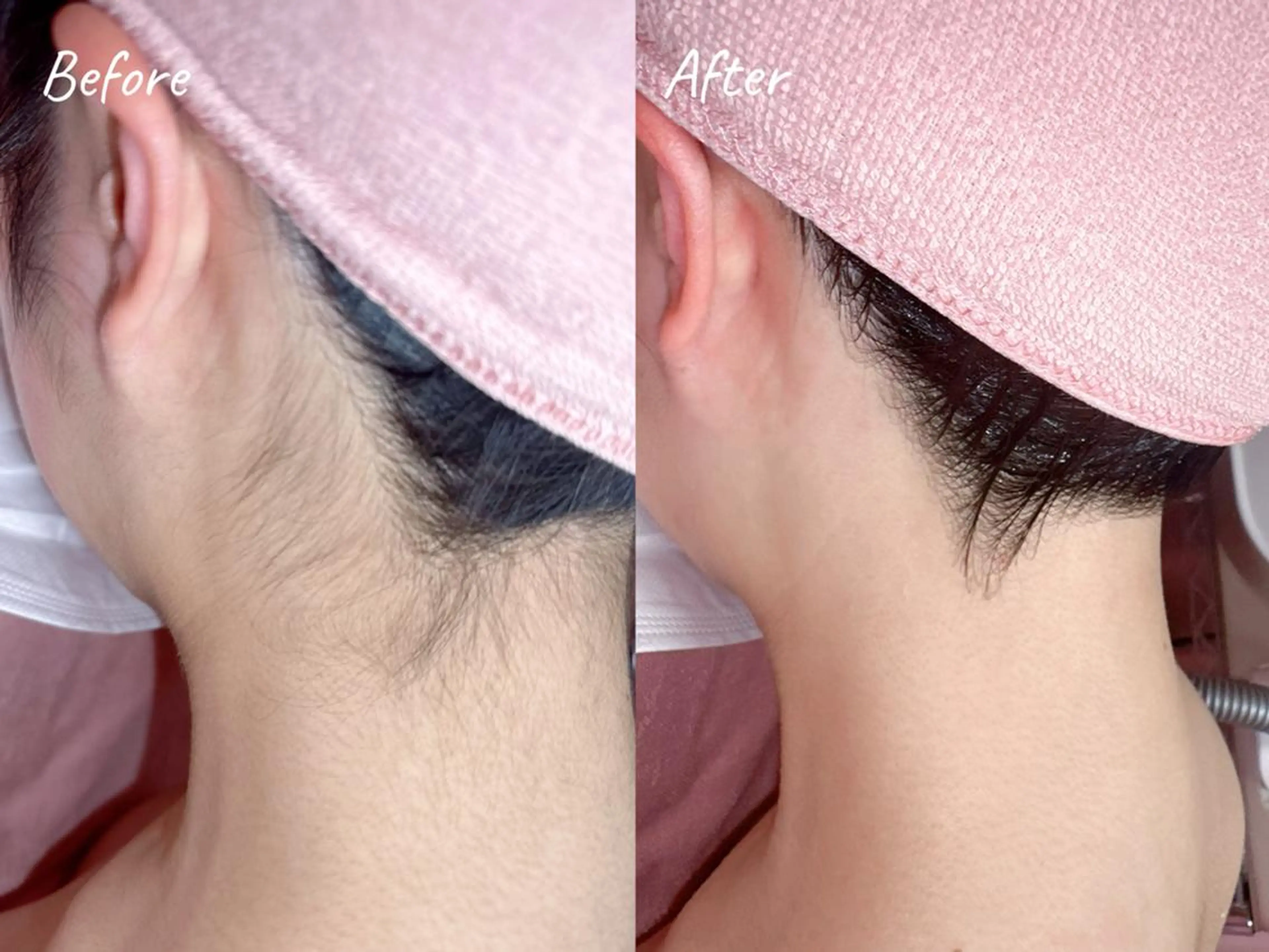 脱毛 脱毛サロンTTe もものエステ・リラクイメージ