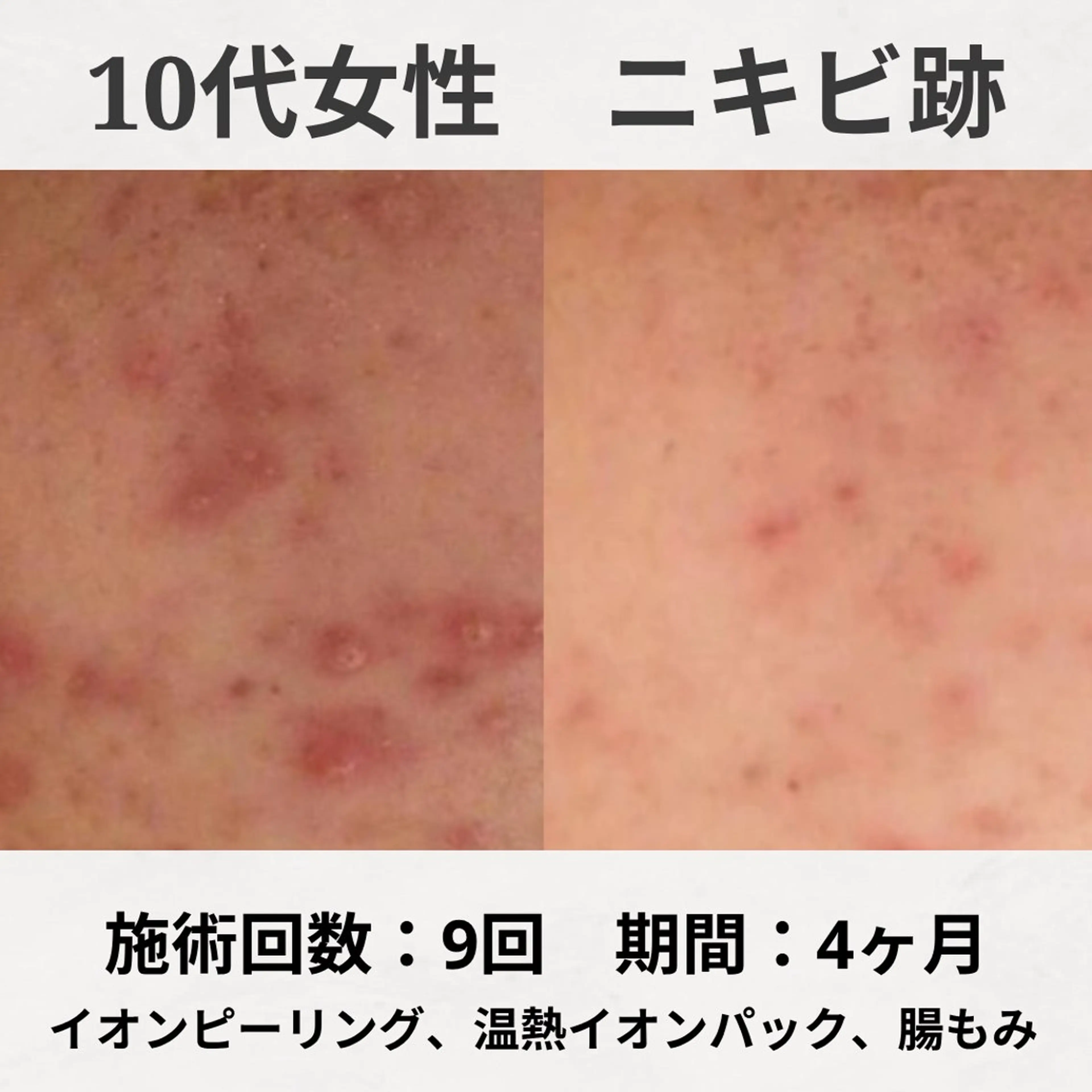 エステ リラク ニキビ跡改善専門🔥 医療にはできない改善のエステ・リラクイメージ