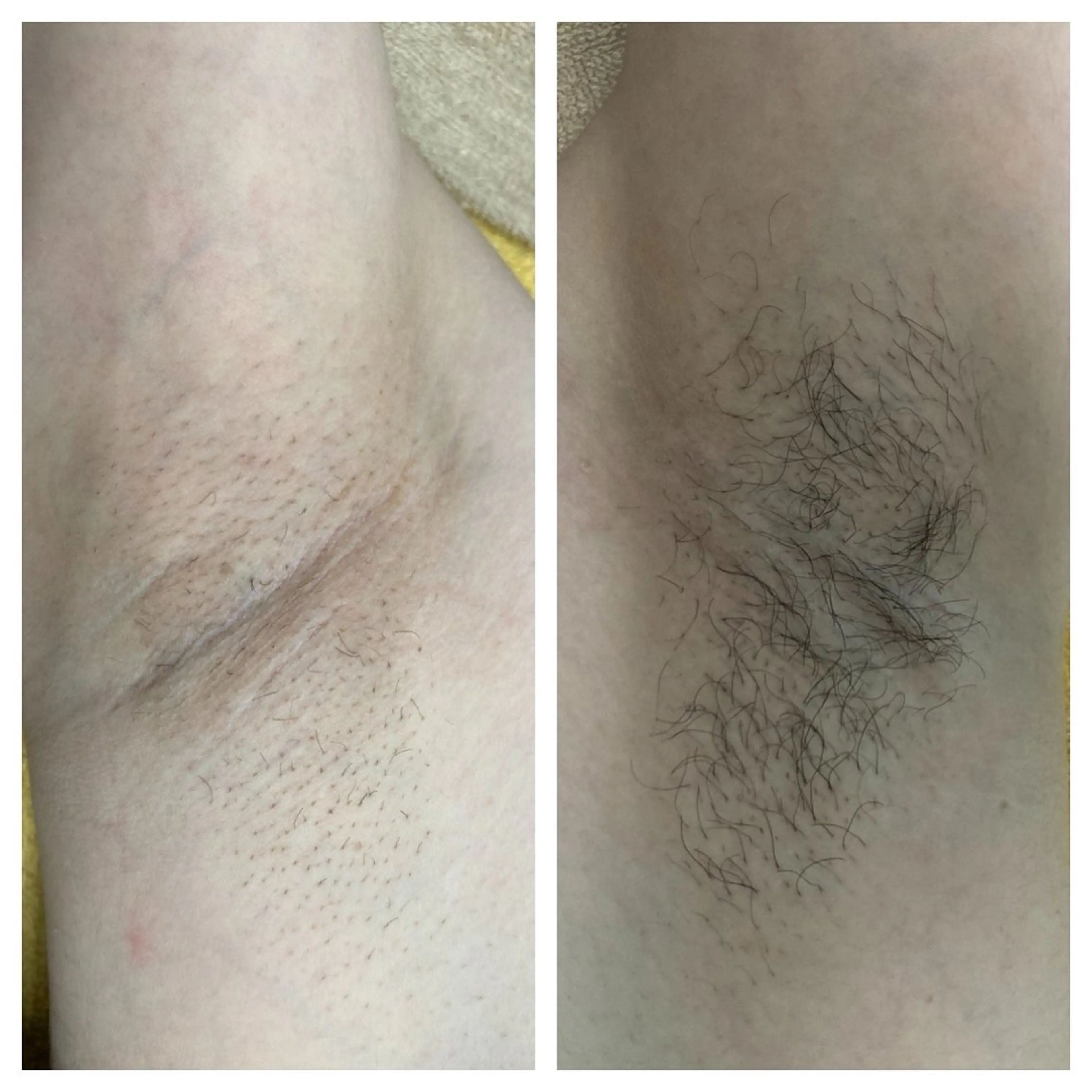 メンズ、レディース同一価格！ワキ脱毛☆の写真