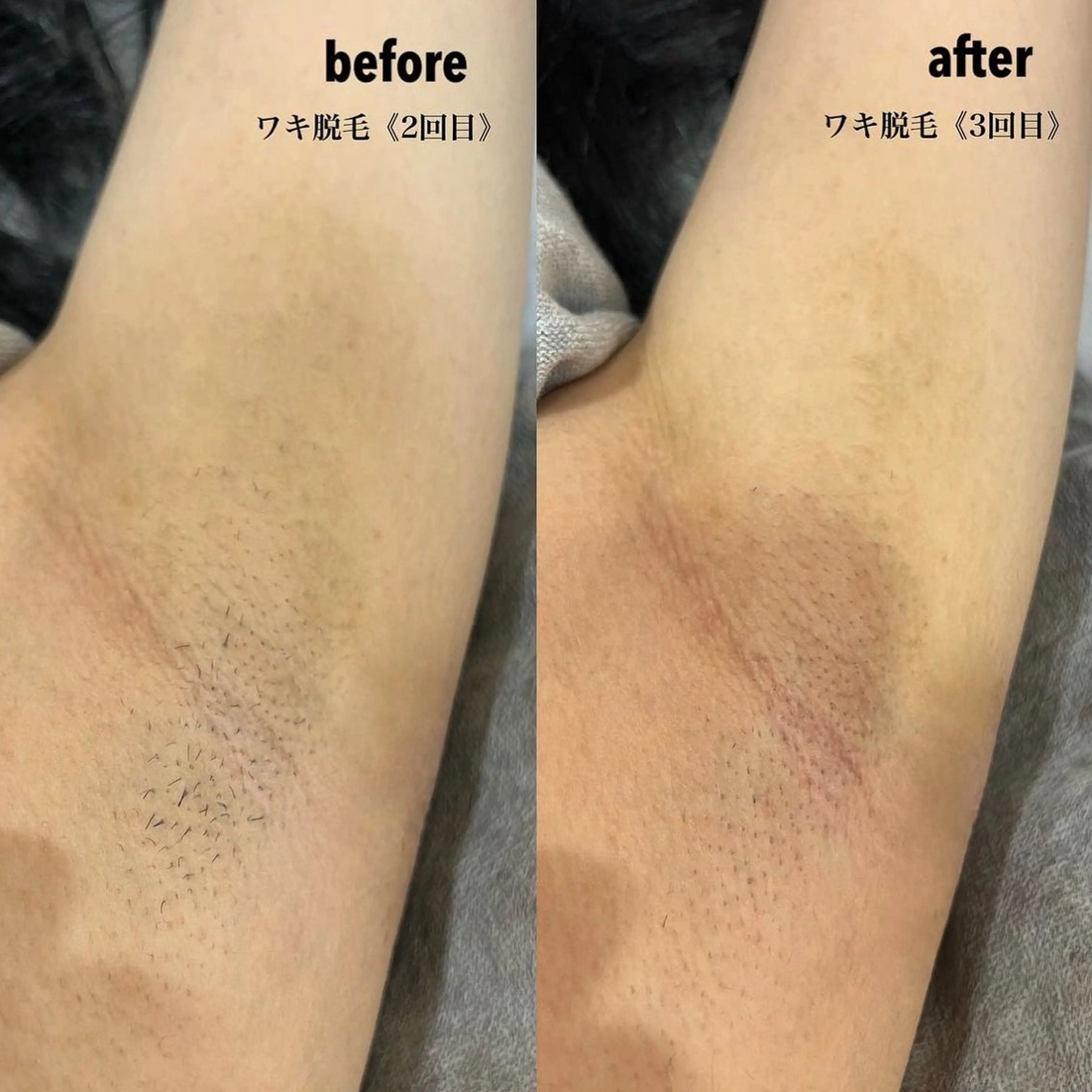 【ワキ脱毛】効果抜群のワキ脱毛✨✨の写真