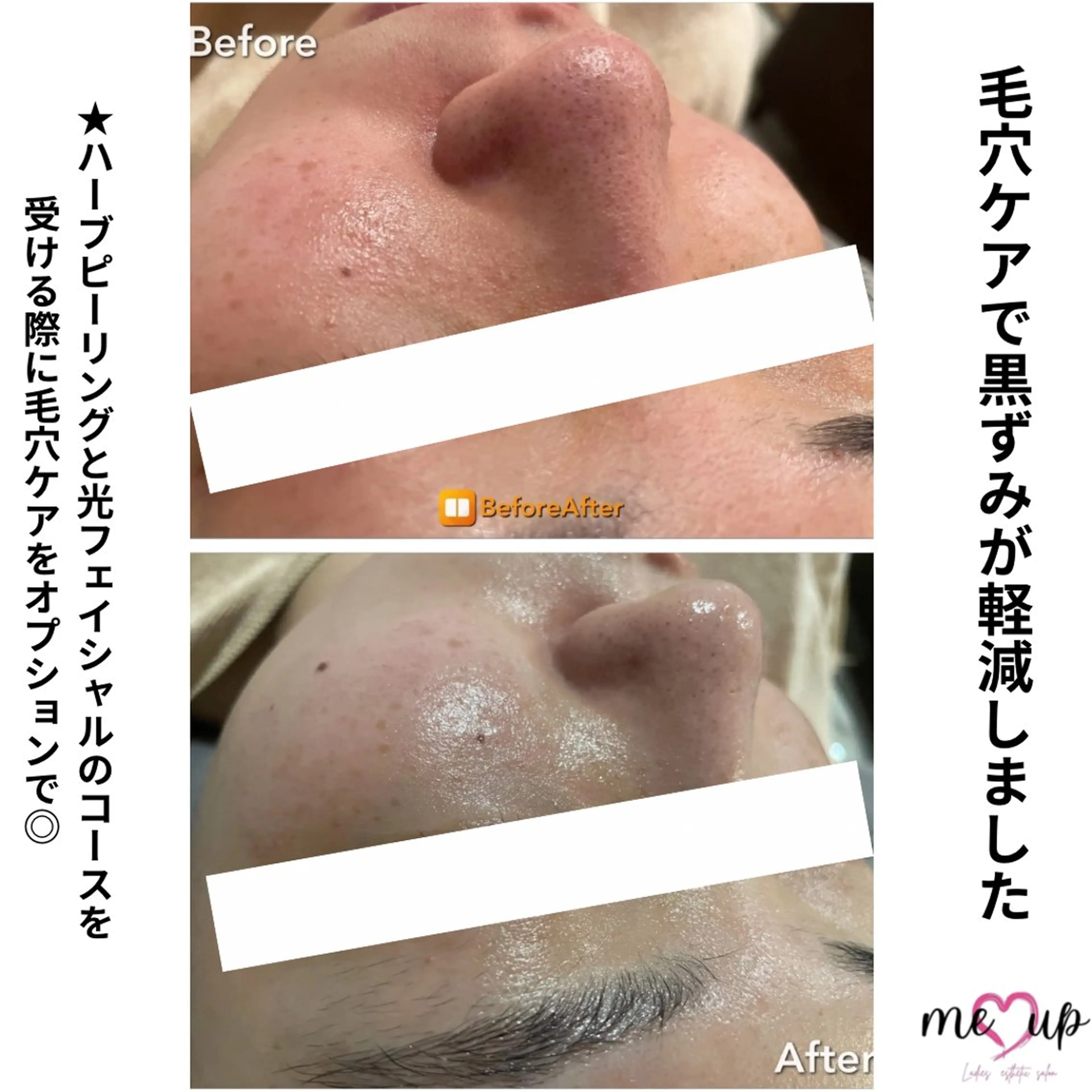 エステ Meupニキビ専門店 背中/ハーブ/肌管理のその他イメージ