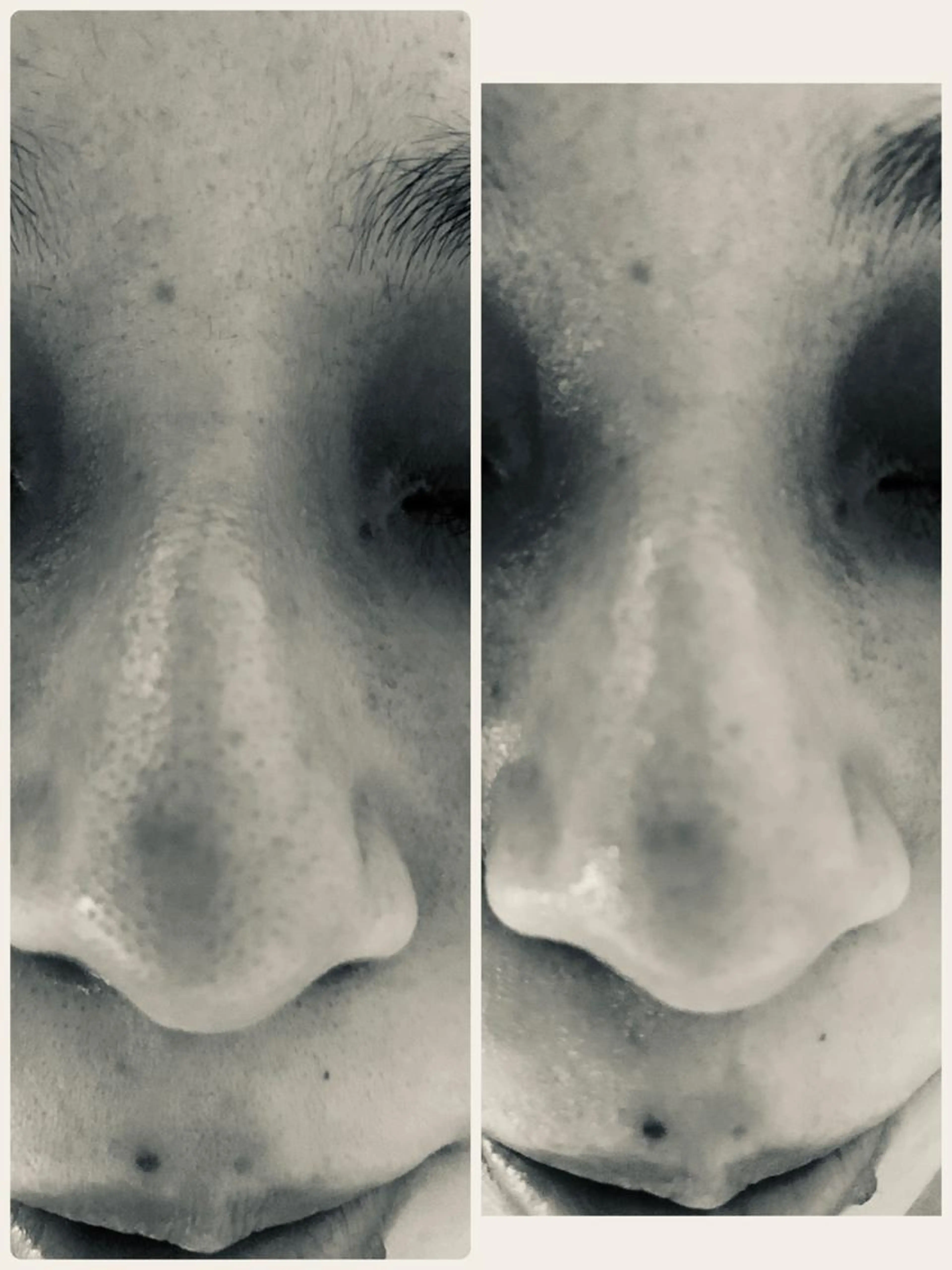 ブツブツ毛穴👃コース★黒ずみ毛穴★たるみ毛穴★開き毛穴★皮脂毛穴の写真
