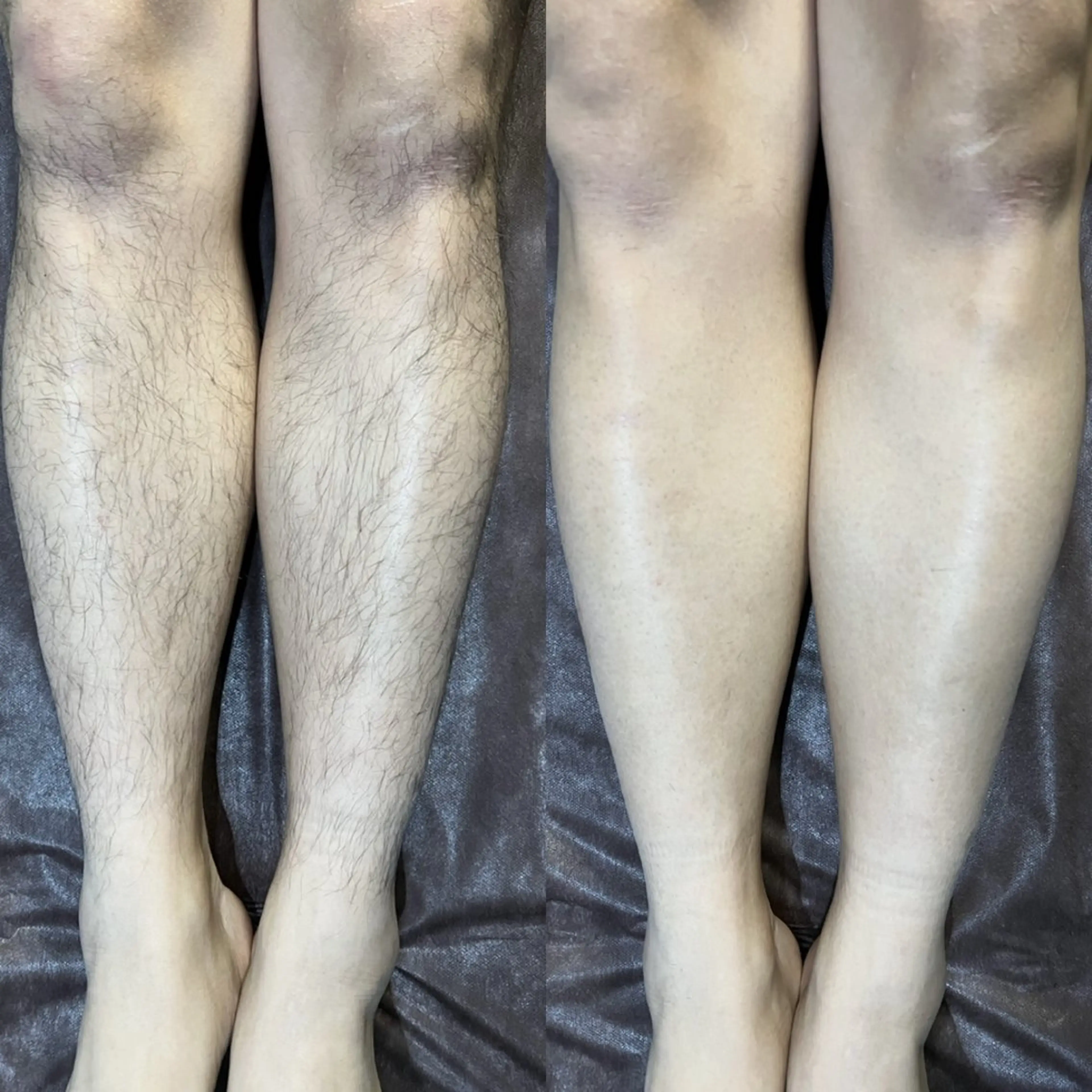 【初回限定】全身脱毛(VIO+顔込)メンズ・レディース OK👫🏻 1回分の写真