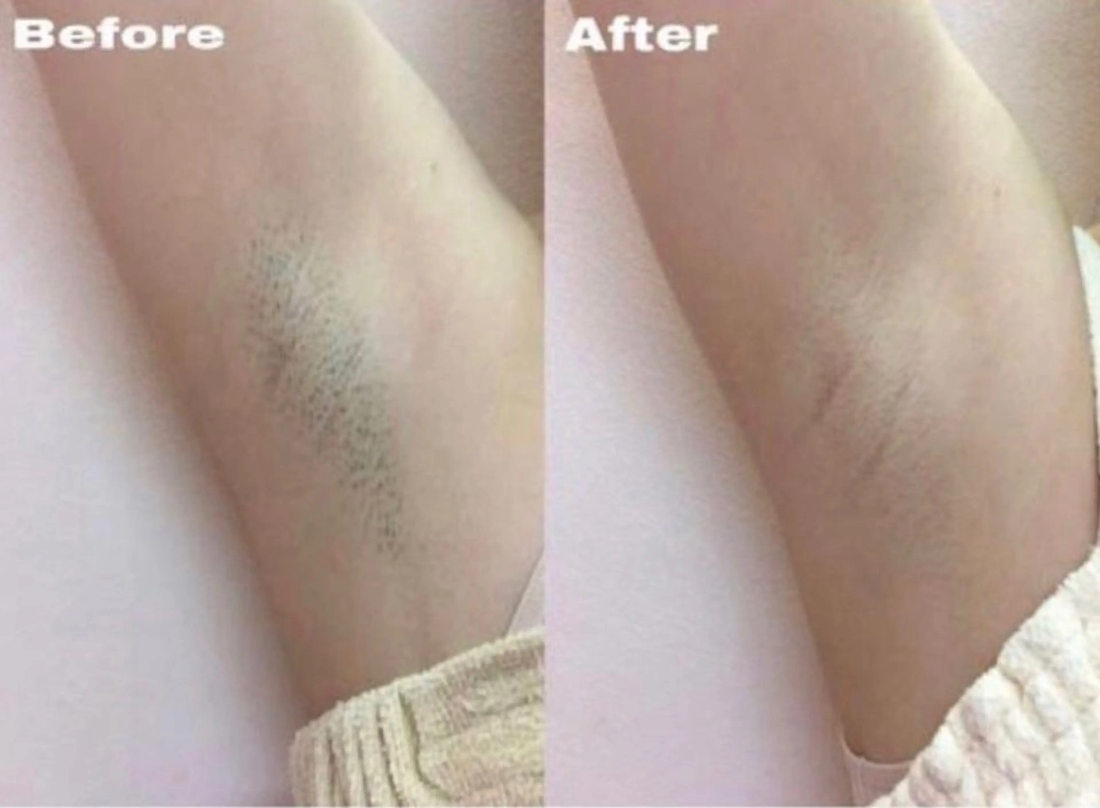 ワキ脱毛¥3300　脱毛デビューにも◎《高出力の高い効果に驚き！》の写真