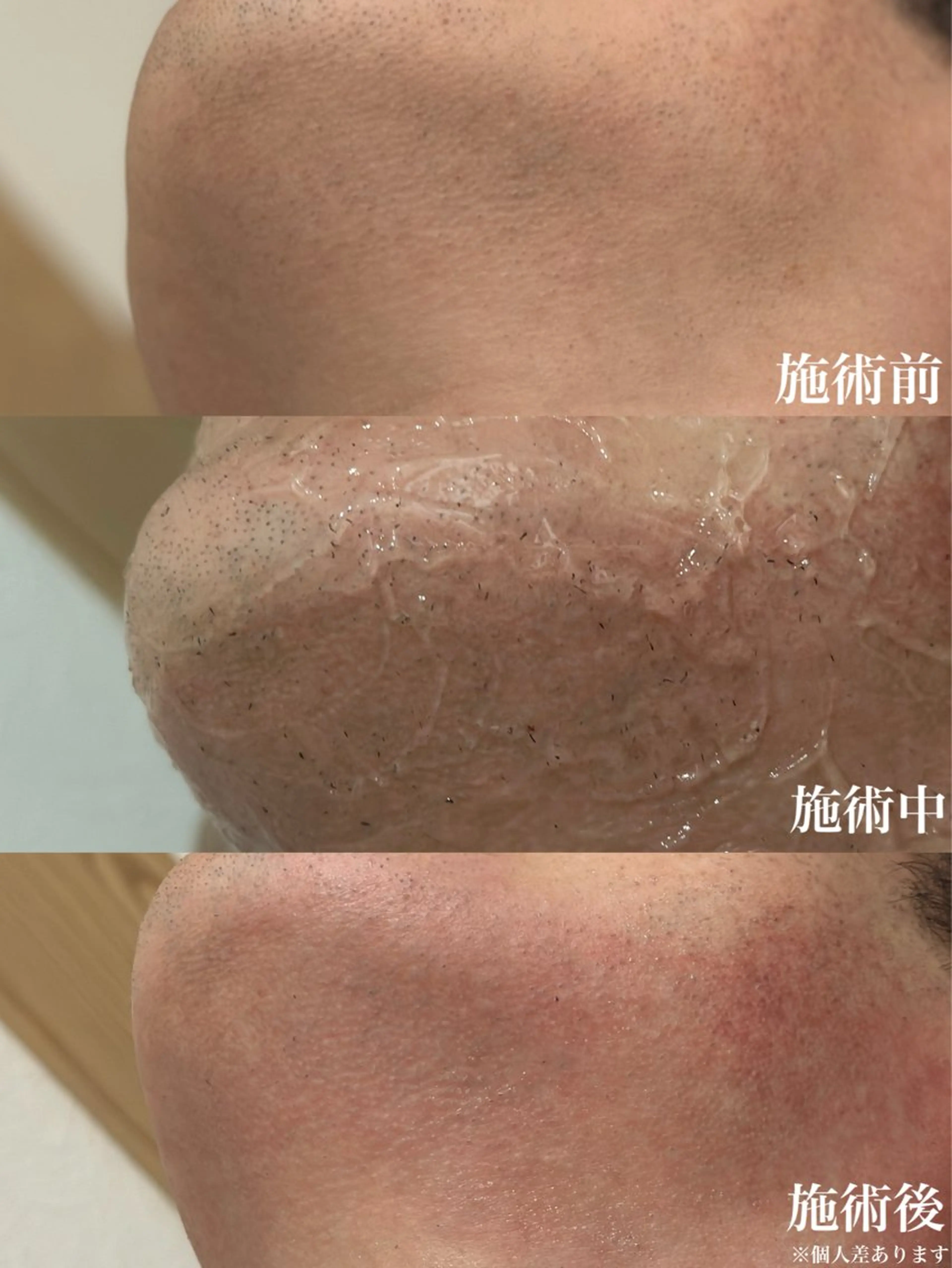 メンズ全身脱毛(顔・VIO込み)の写真