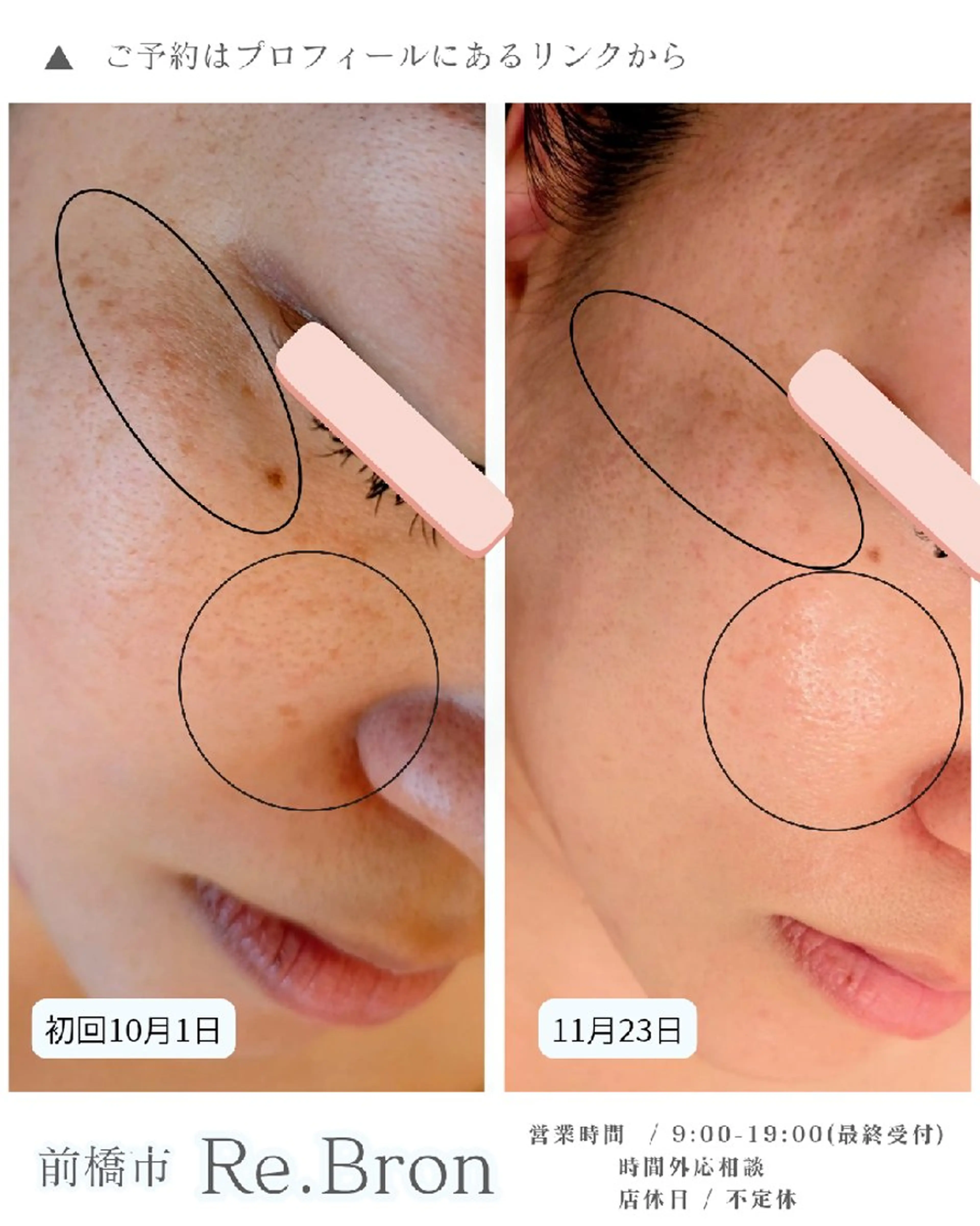 エステ リラク 毛穴ケア くすみ肌 ハーブピーリングのエステ・リラクイメージ