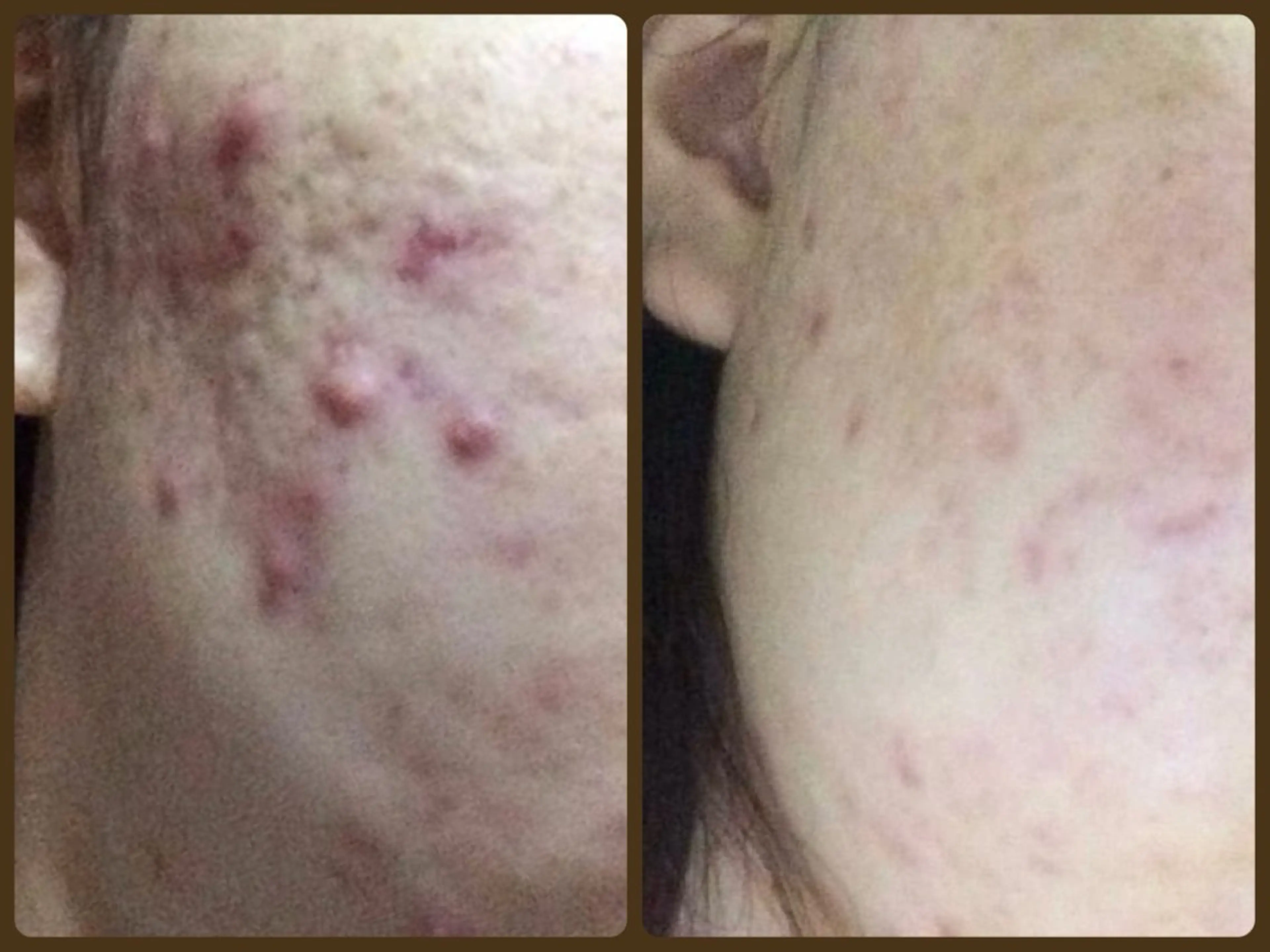 ニキビ・ 肌荒れ専門店のエステ・リラクイメージ