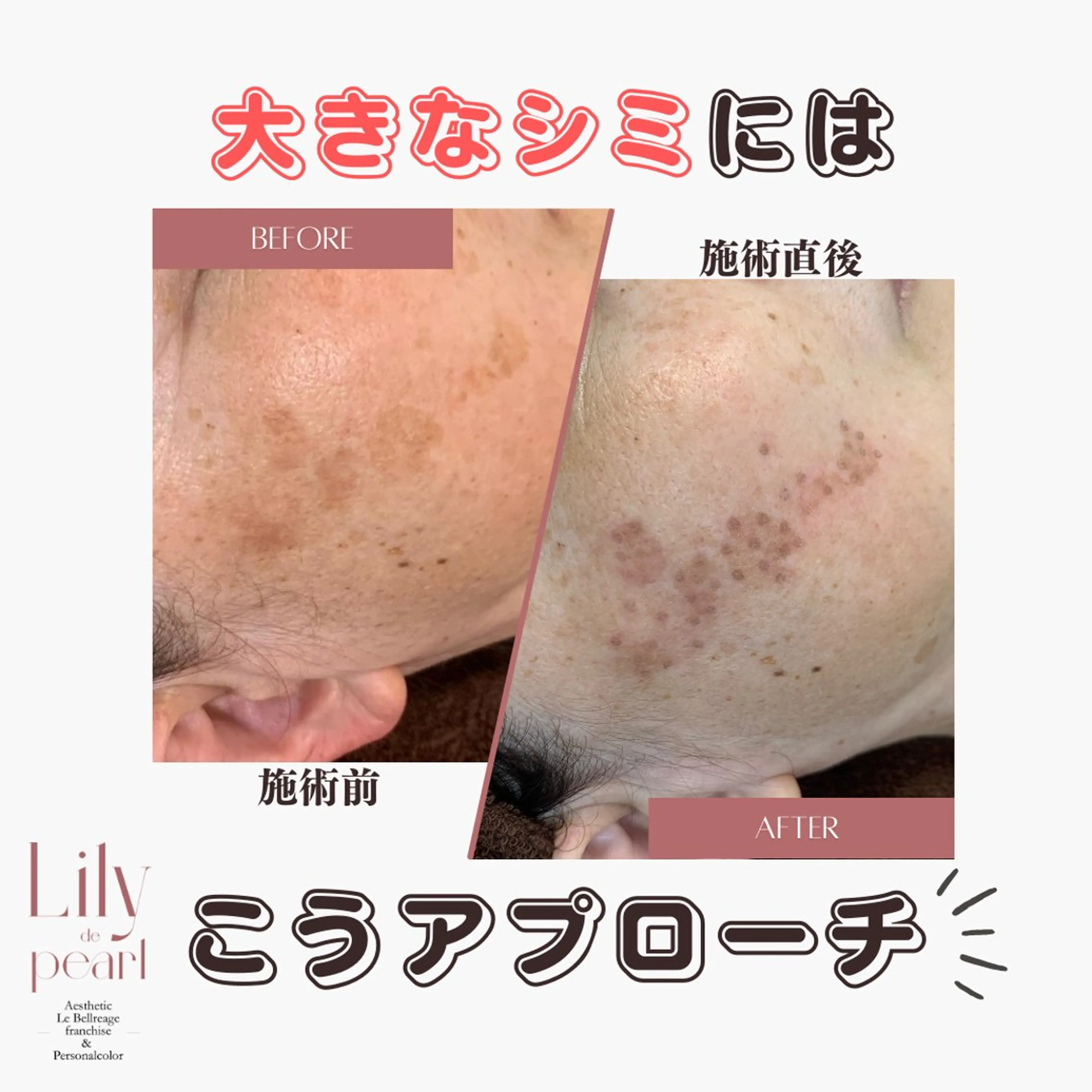 エステ 最新シミケアLily de pearlのエステ・リラクイメージ