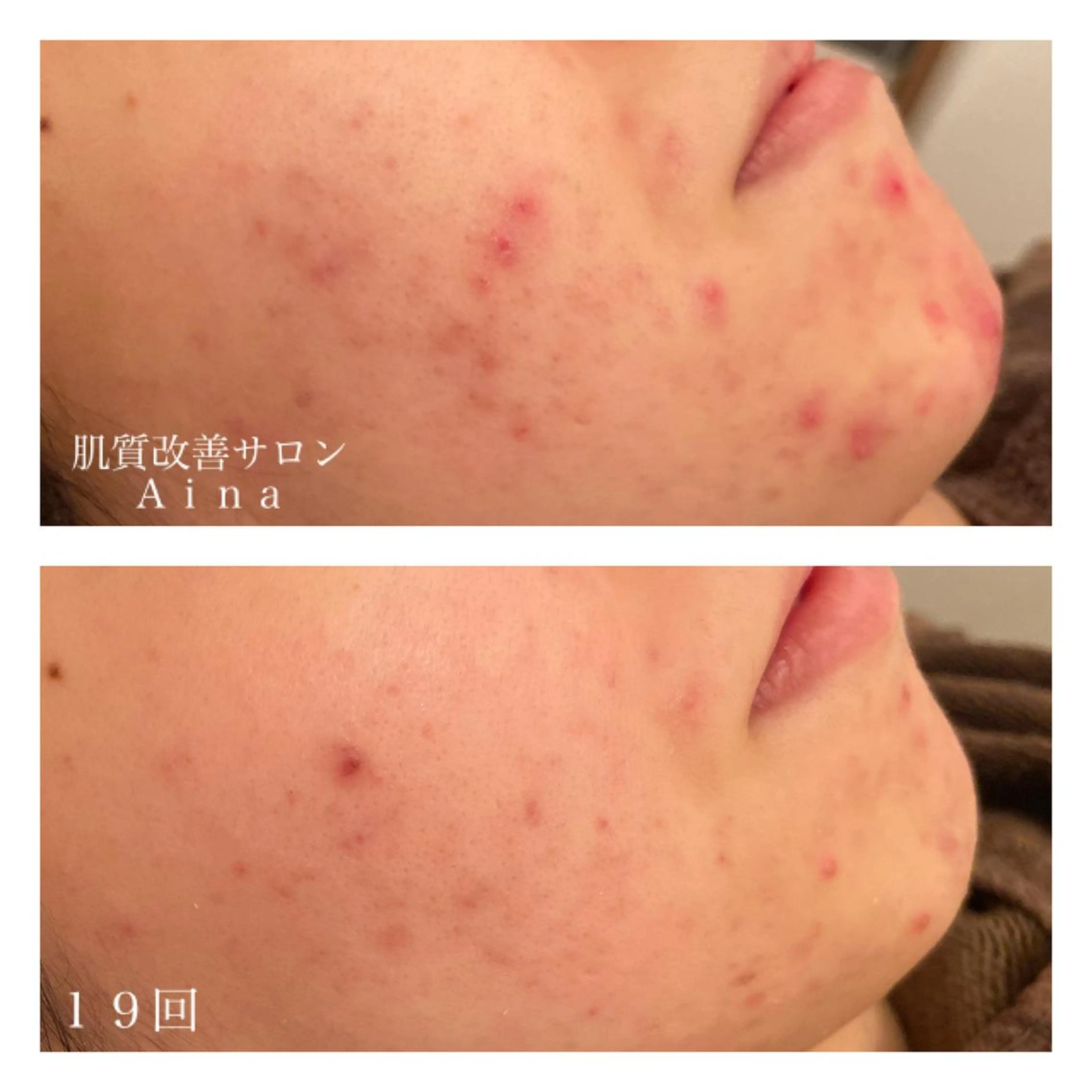 セミロング カラー パーマ ヘアアレンジ メンズ キッズ ネイル マツエク・マツパ 赤色 エステ リラク ニキビ跡専門サロン Ａｉｎａのエステ・リラクイメージ