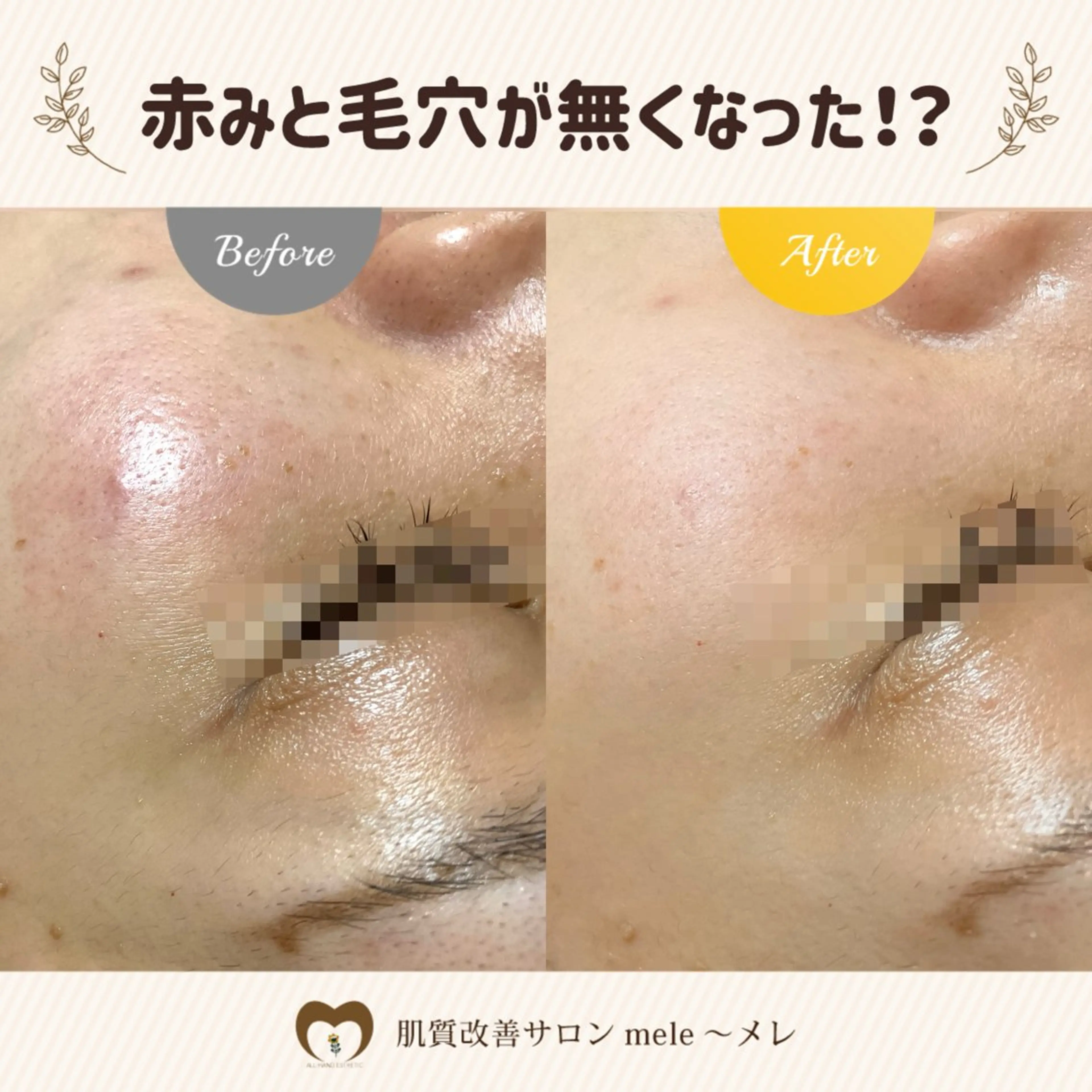 繰り返すニキビ・毛穴 ✨つくば肌質改善専門のエステ・リラクイメージ