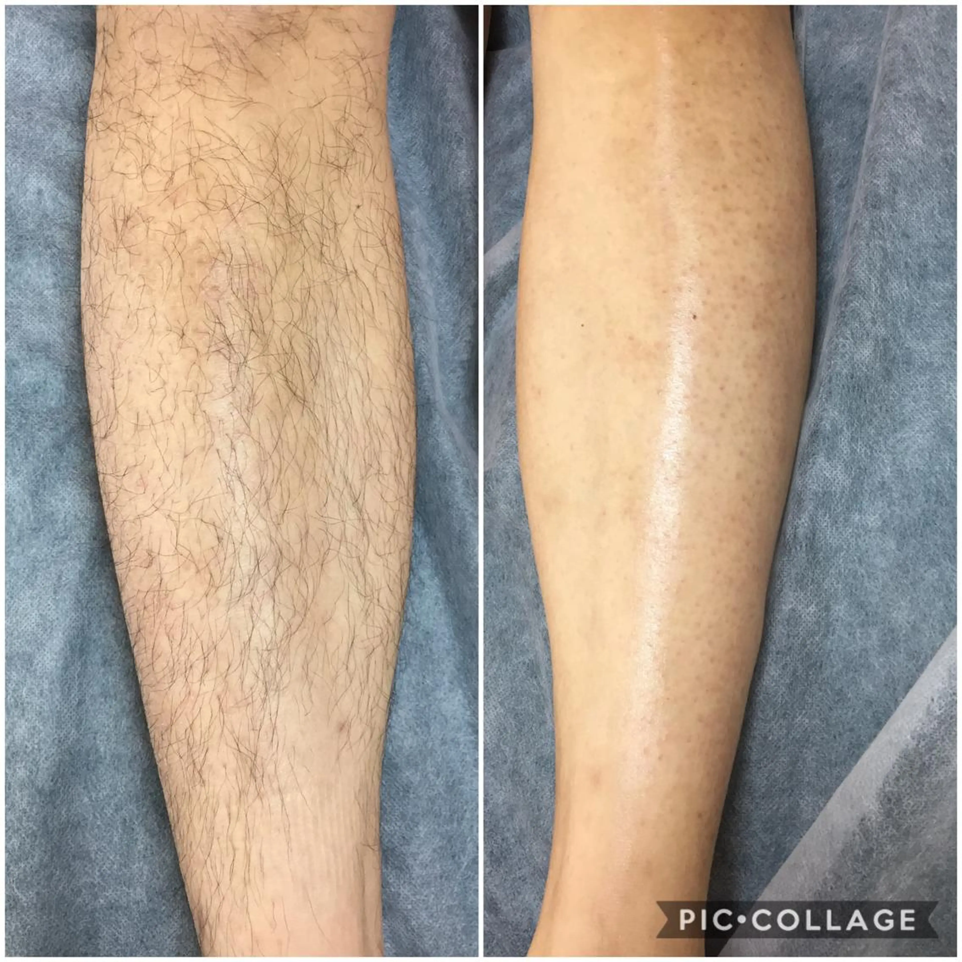 【男性】両脚ひざ下の写真