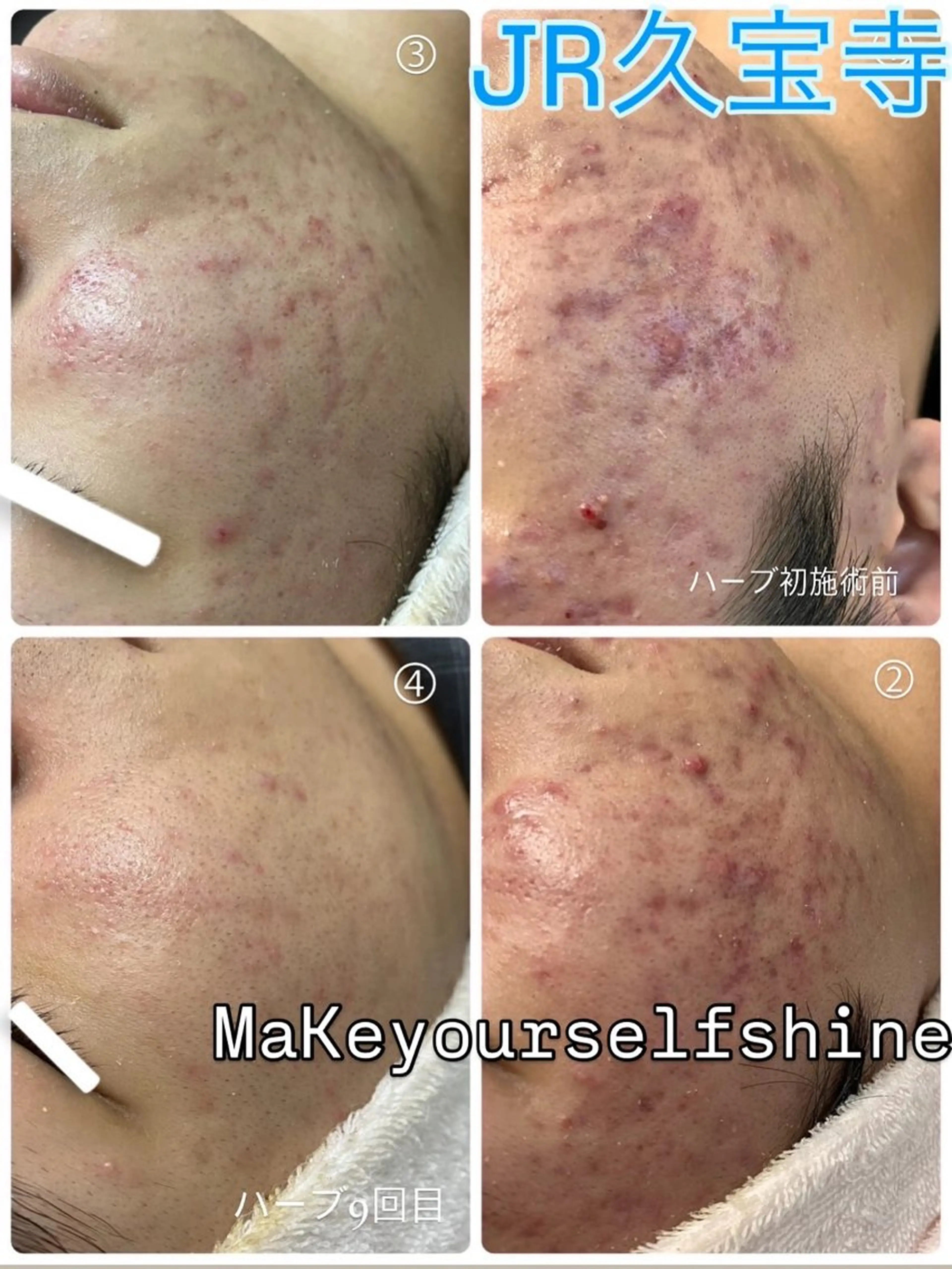 《ハーブピーリング🌿シミや毛穴へハーブピーリング🌿顔/背中/お尻》メンズ専用の写真