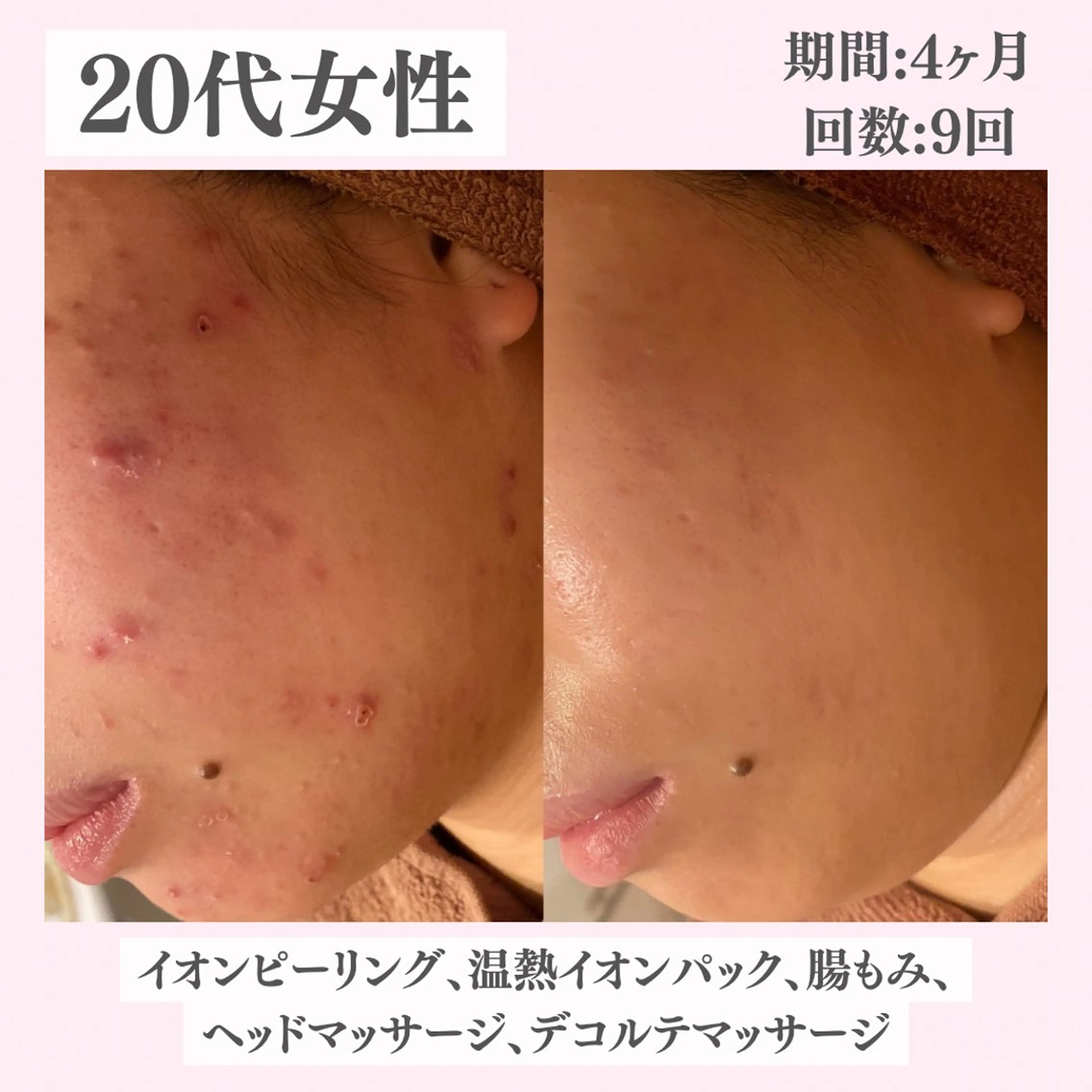 エステ リラク ニキビ・肌質改善専門 ♡人生が変わるサロンのエステ・リラクイメージ