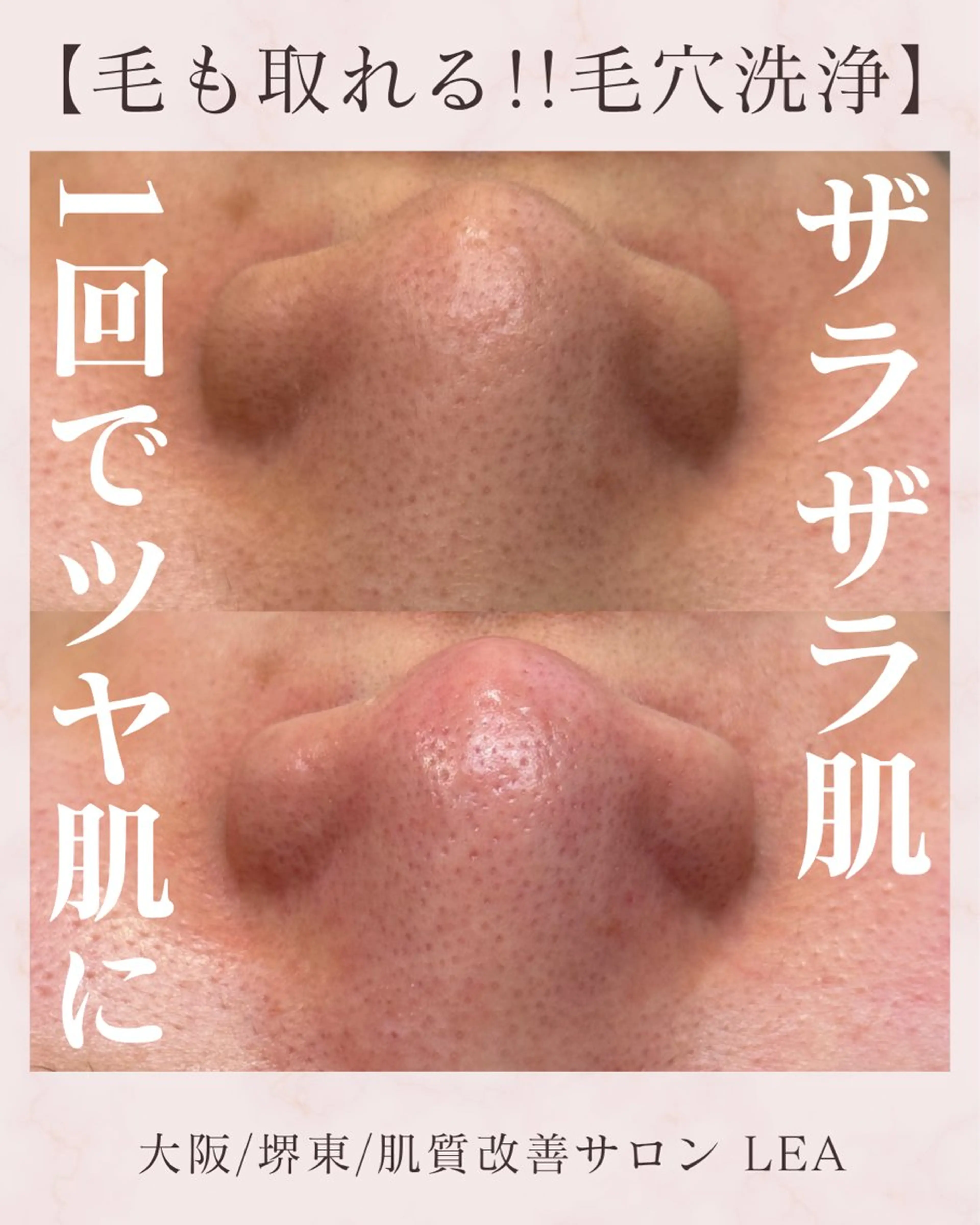 エステ Lea堺東　毛穴洗浄 ×顔ワックス脱毛のその他イメージ