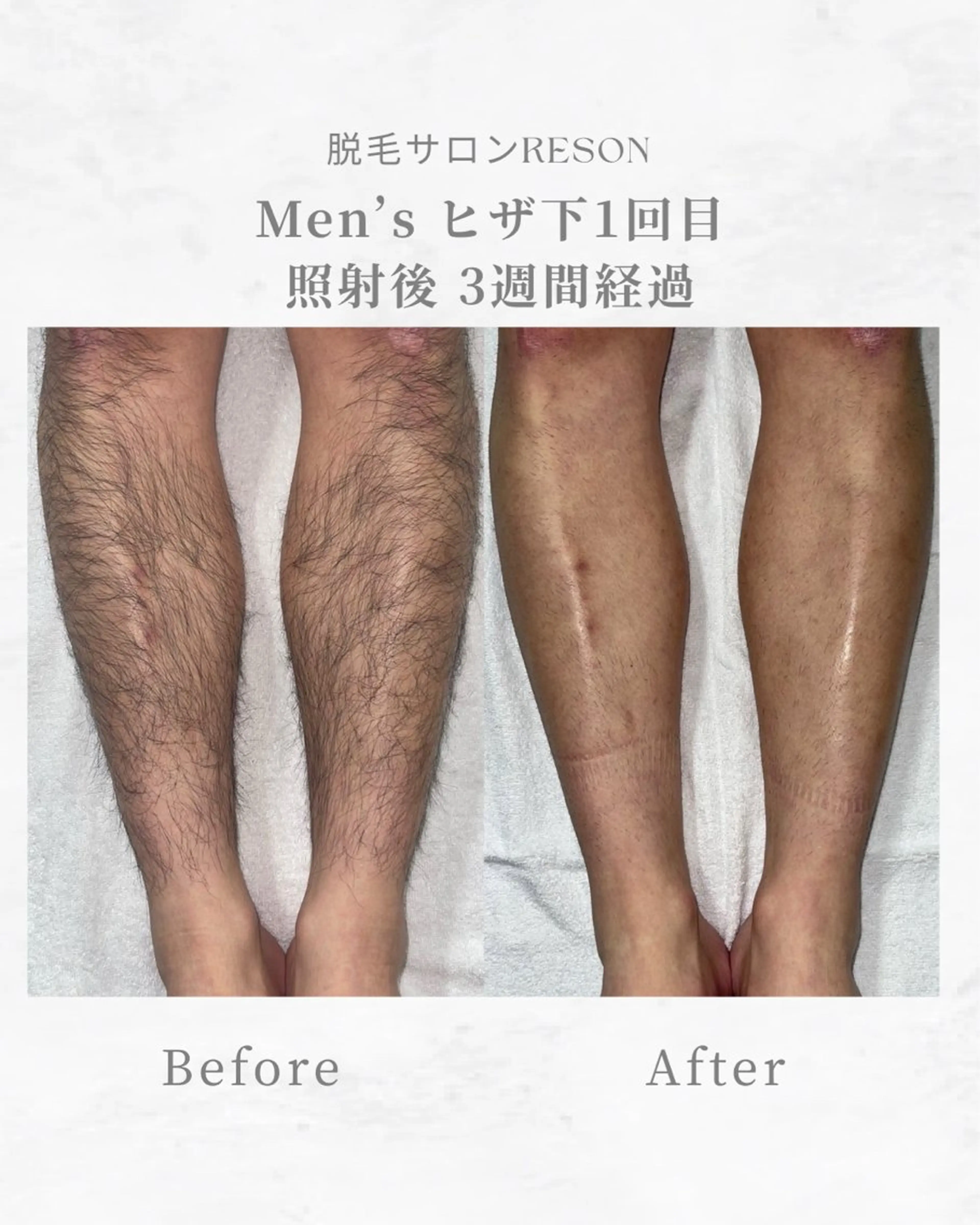 メンズ 都度払いの脱毛サロン RESONのエステ・リラクイメージ