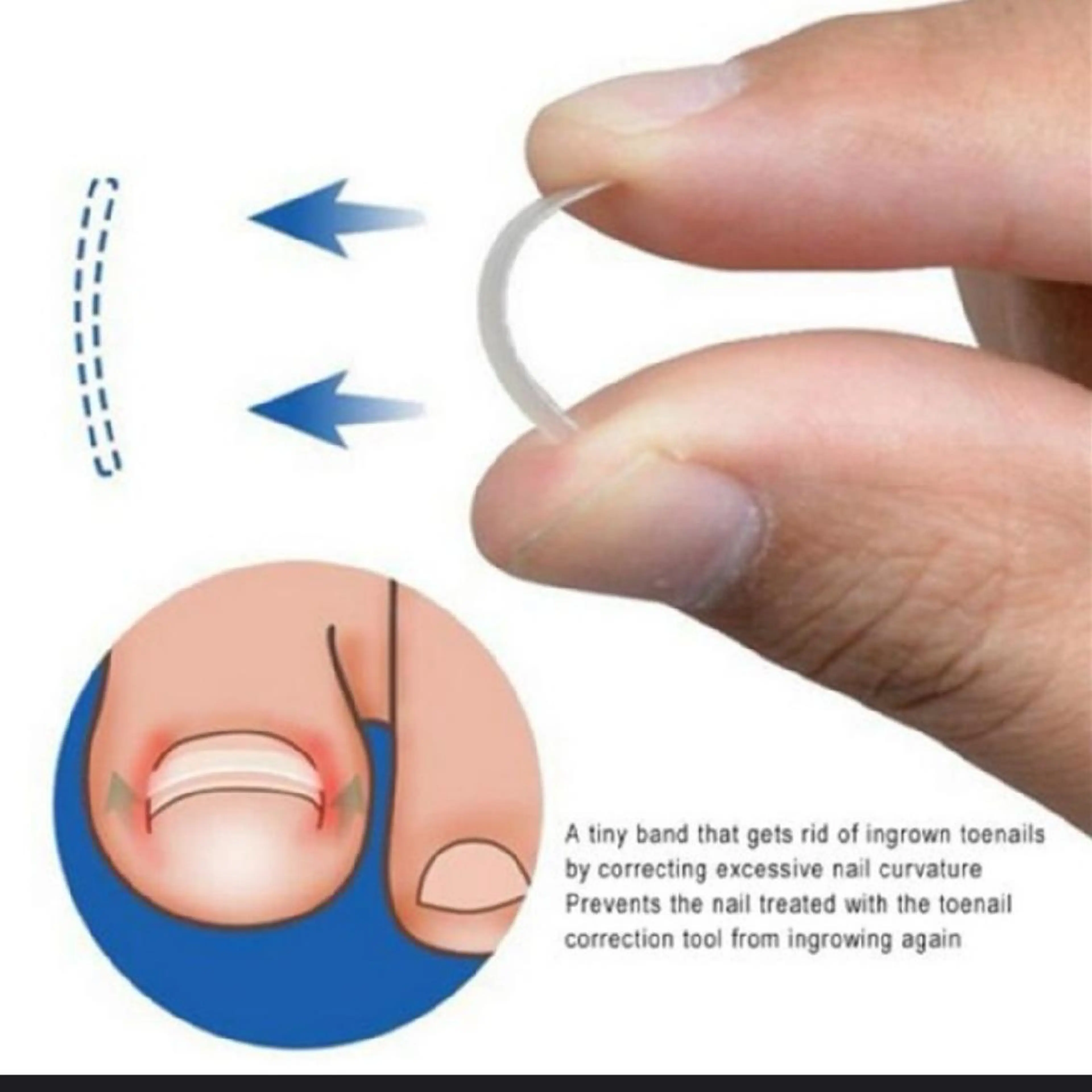 フット巻き爪矯正！切らない！痛くない！の写真