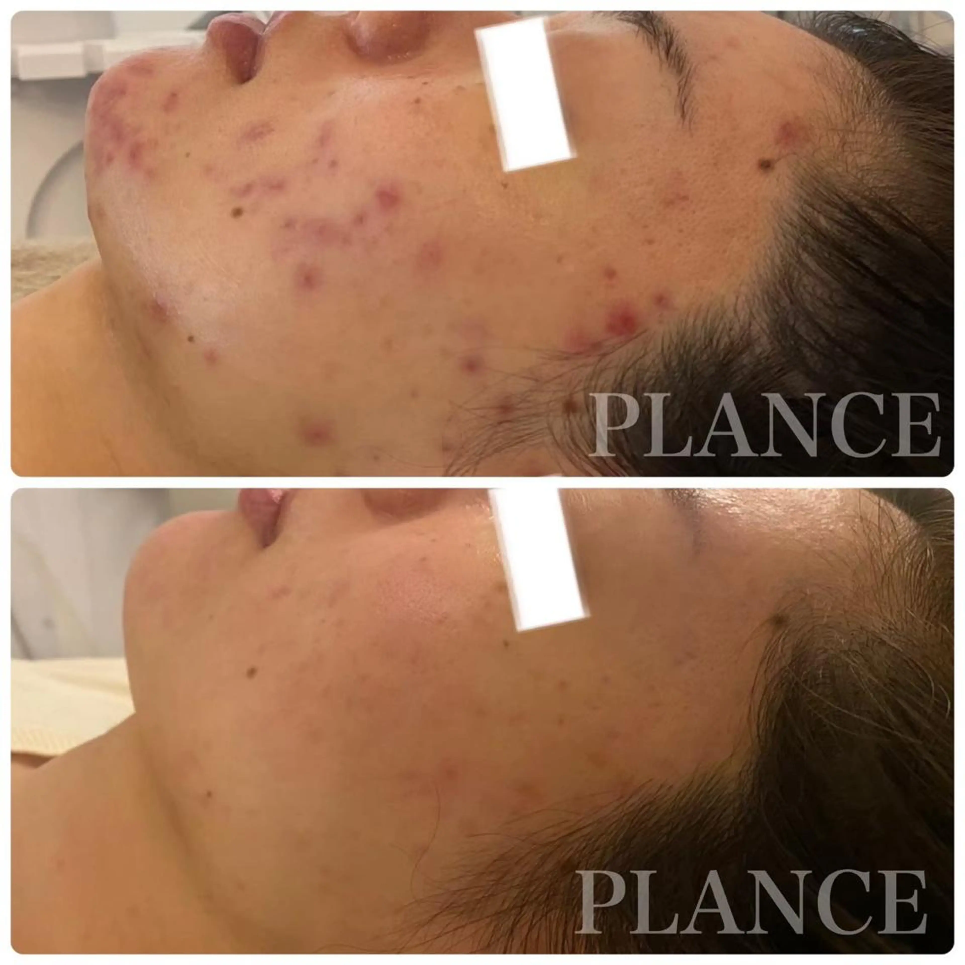 エステ フェイシャル専門 肌質改善/プランスのエステ・リラクイメージ