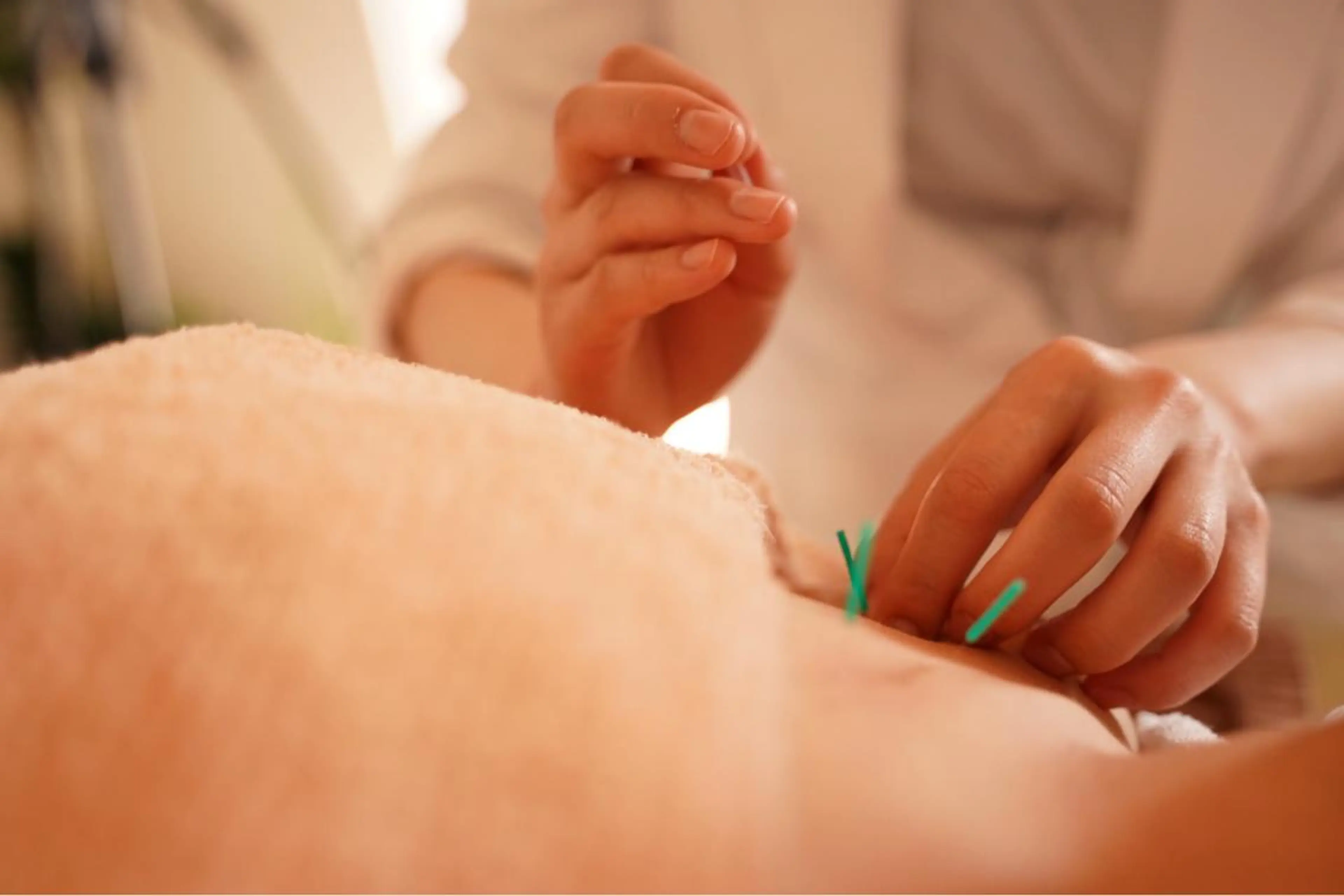 【minimo限定❤✨】ボディ鍼灸ケア 60分🌟特別価格にて✨の写真