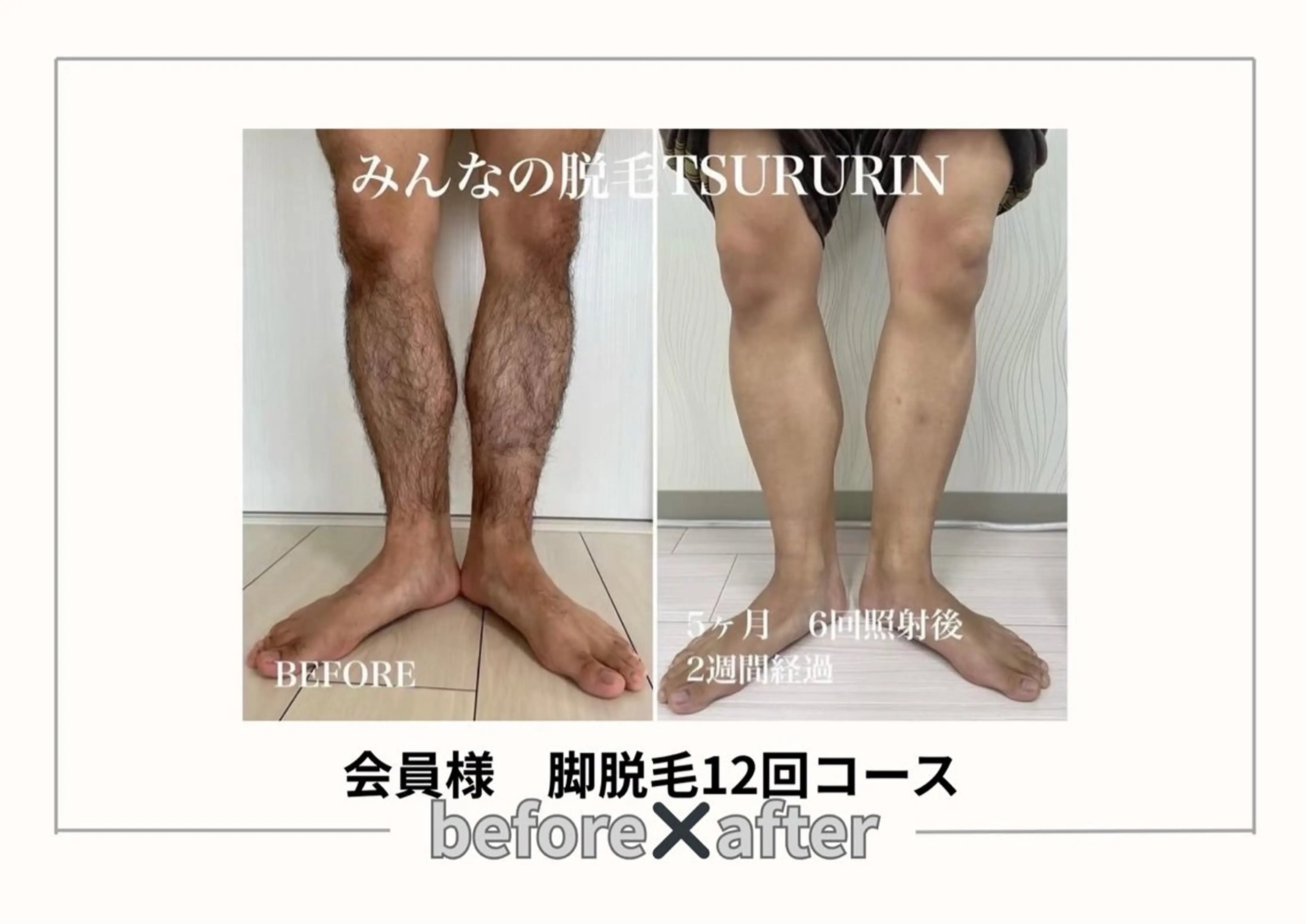 初回限定🌟男性腕or脚セット脱毛👱‍♂️通常¥10,000→¥5,000‼️（肘上下・手高指）or（膝上下・脚高指）の写真