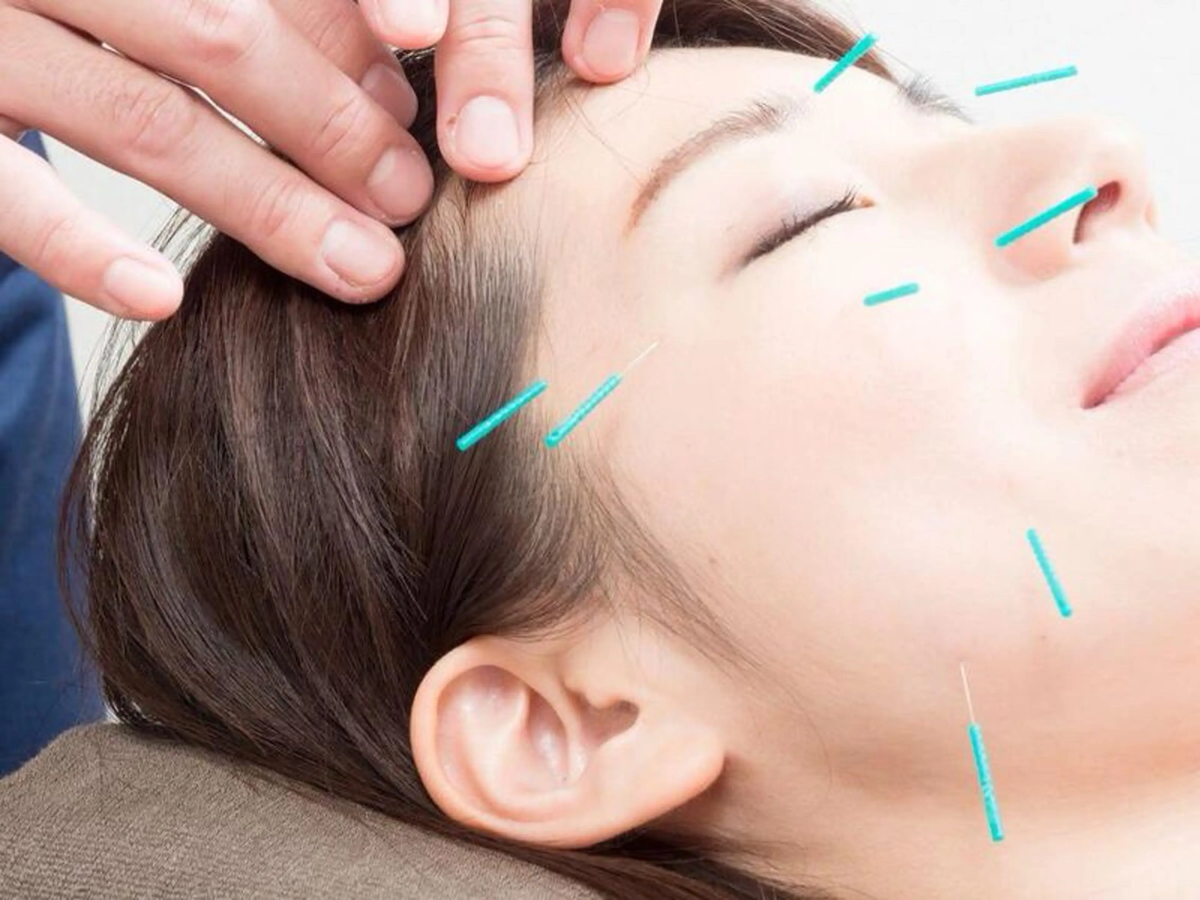 【初回12％off！美容鍼】頭痛、眼精疲労、食い縛りも改善（ヘッドマッサージ付）30分​〜​の写真