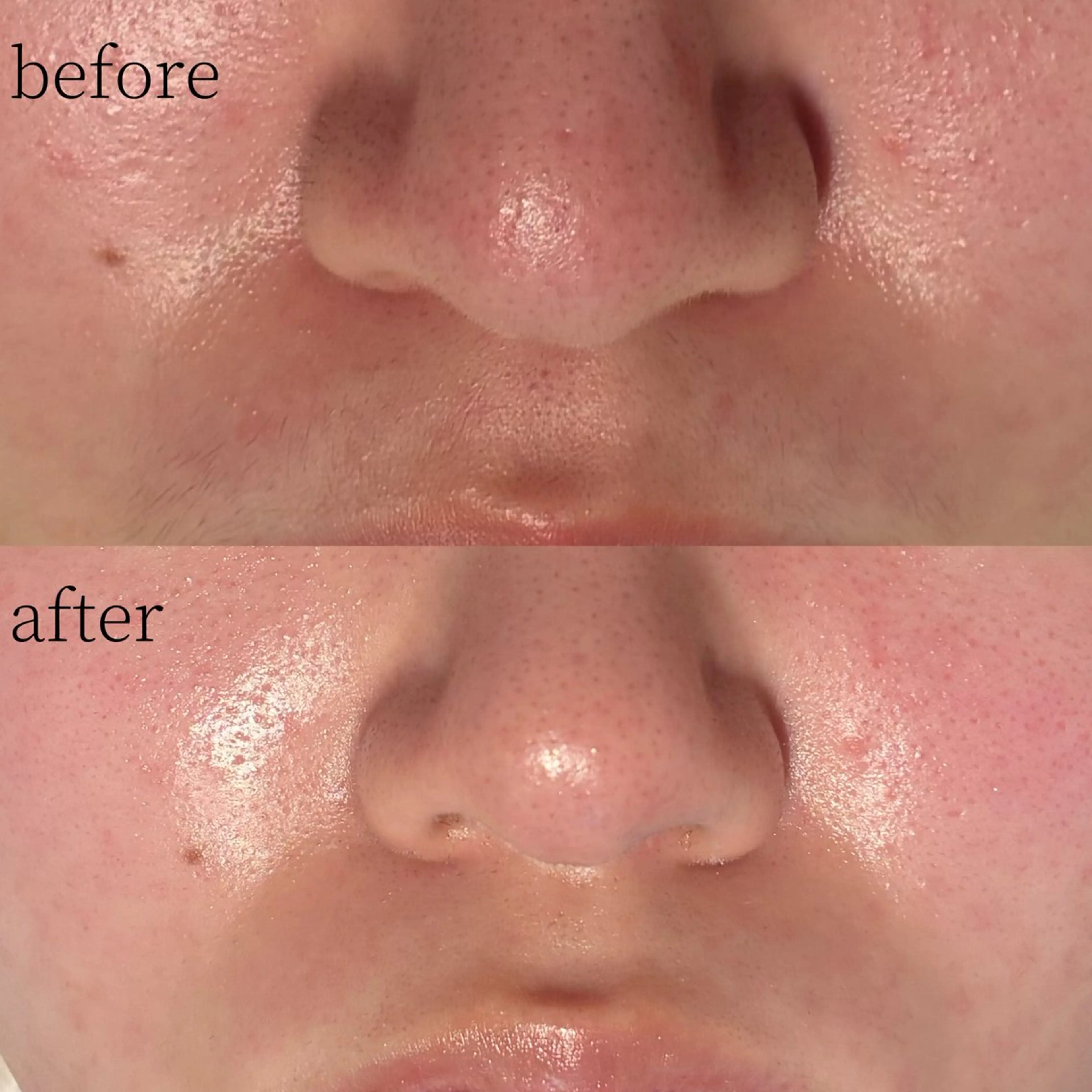 【毛穴・くすみケア】フェイスワックス✨透明感UP/相模大野の写真