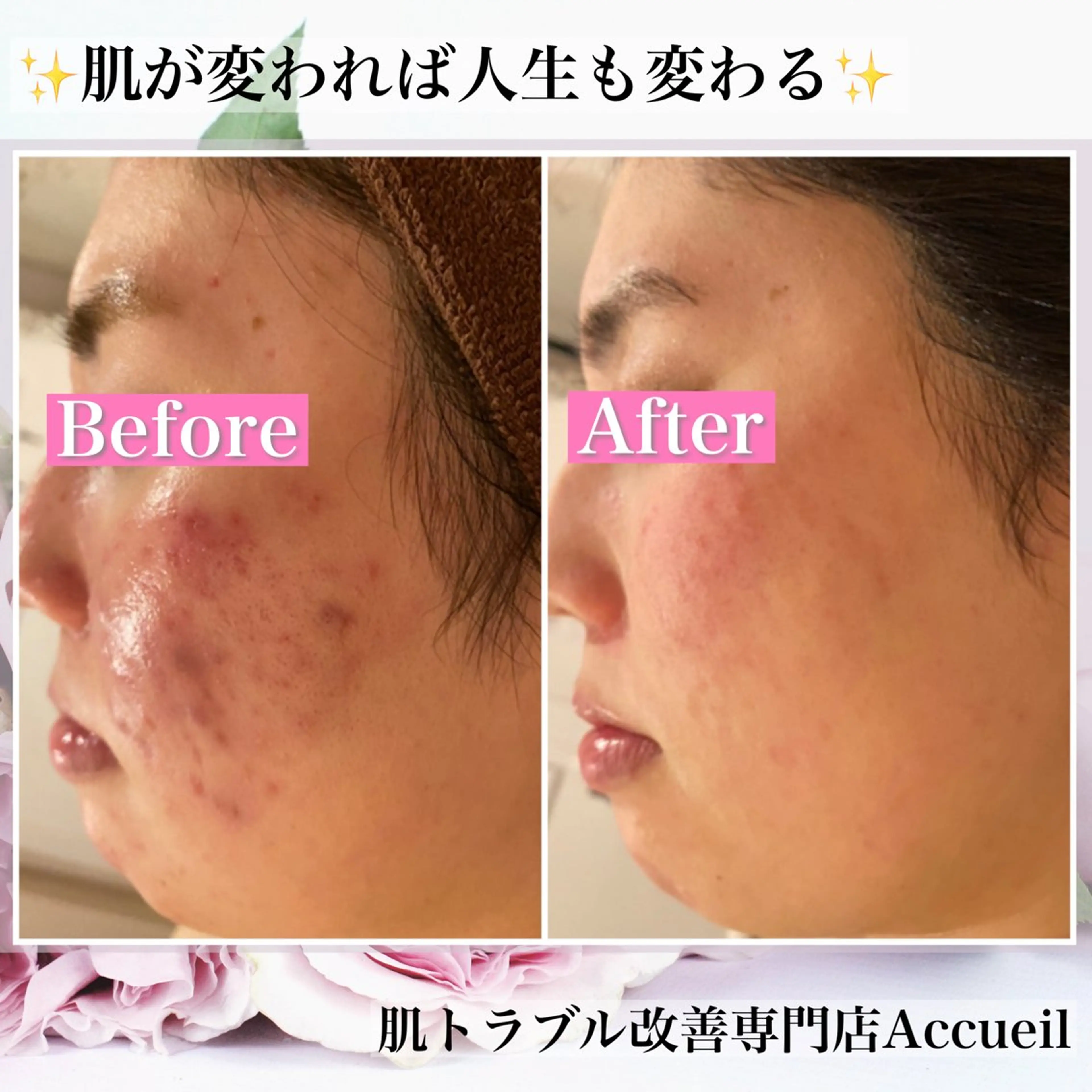 エステ リラク ニキビ・肌質改善専門 ♡人生が変わるサロンのエステ・リラクイメージ