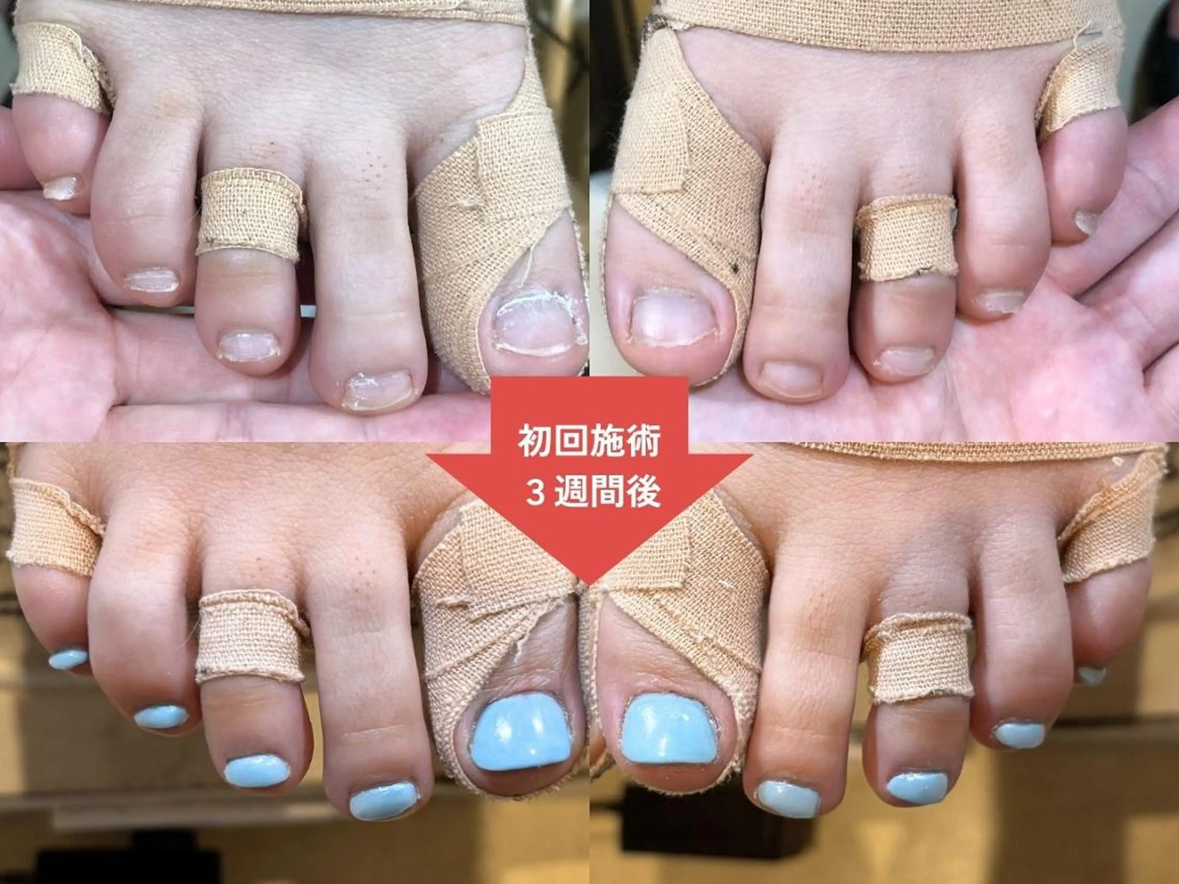 ネイル 深爪矯正・自爪育成 ネイルサロンアモまいのネイルデザイン