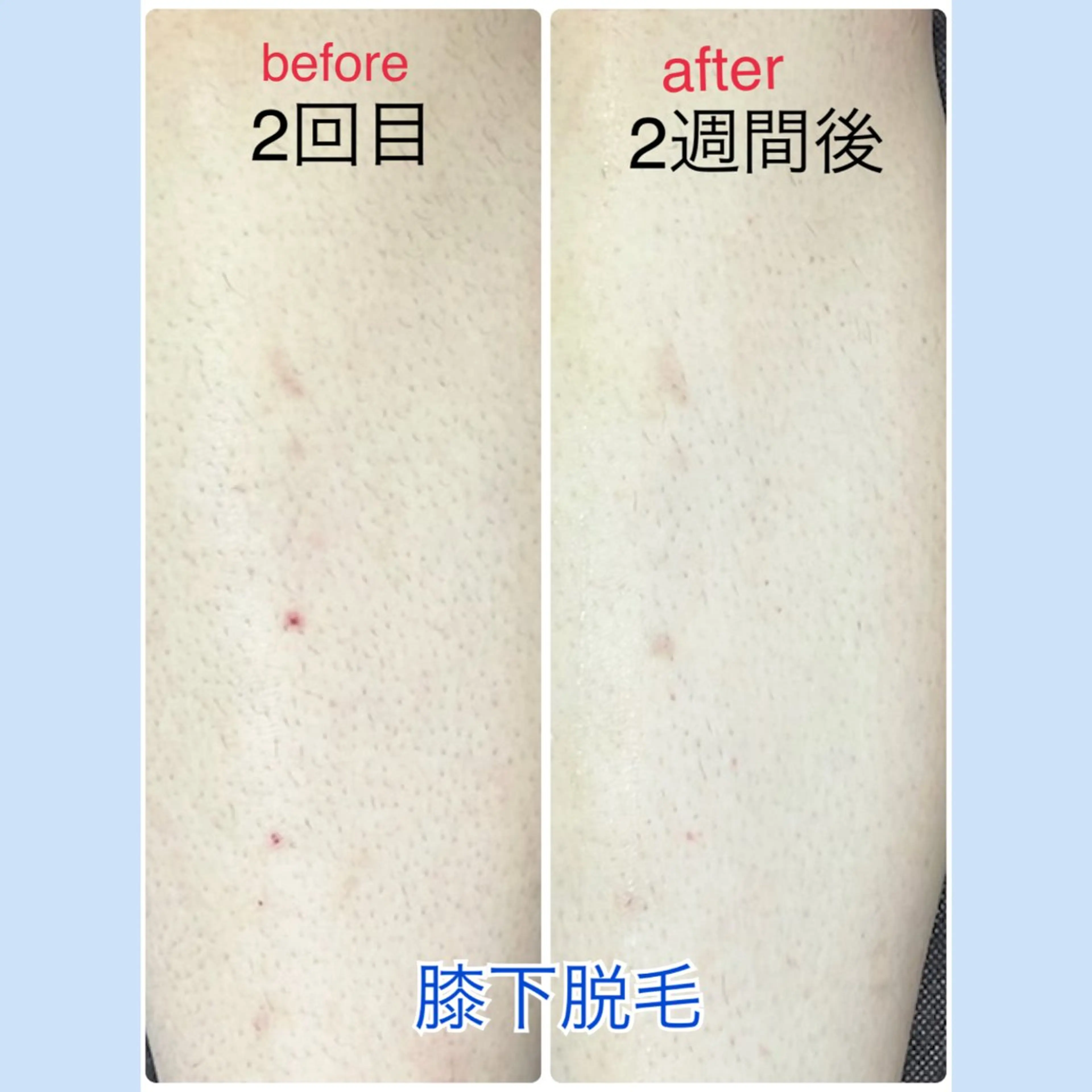 脱毛 光フェイシャル・脱毛 MIA.ROSAのエステ・リラクイメージ