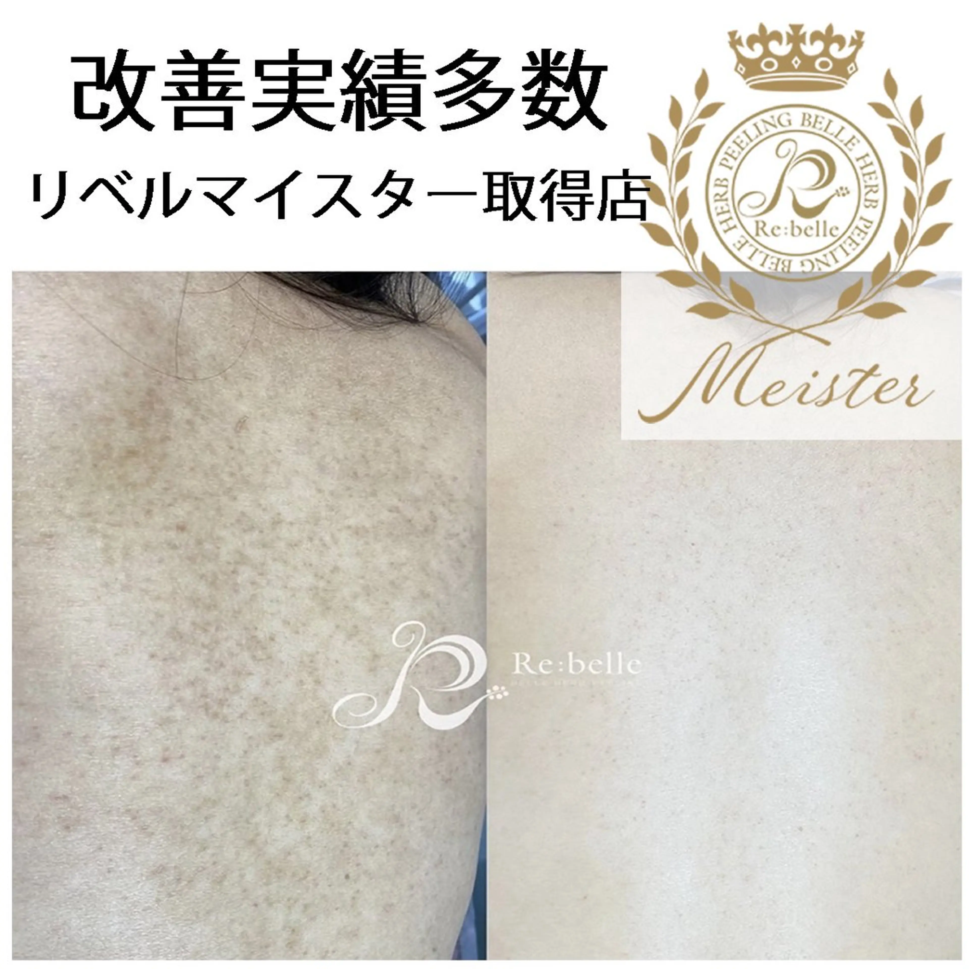 【剥離あり/ニキビケア毛孔性】リベルハーブピーリング背中上（2000円券付）90分の写真