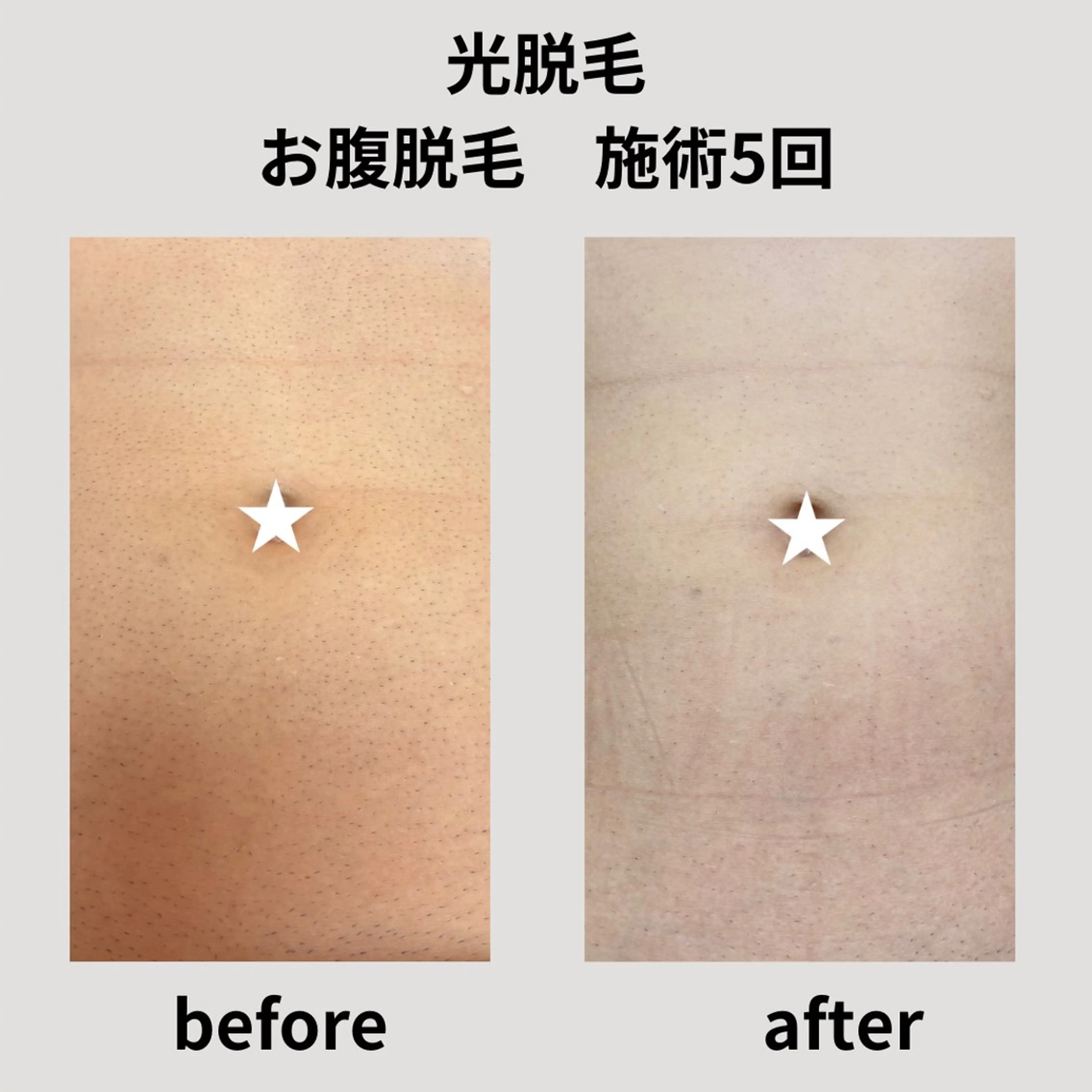 脱毛 脱毛＆フェイシャル H'euriaのエステ・リラクイメージ