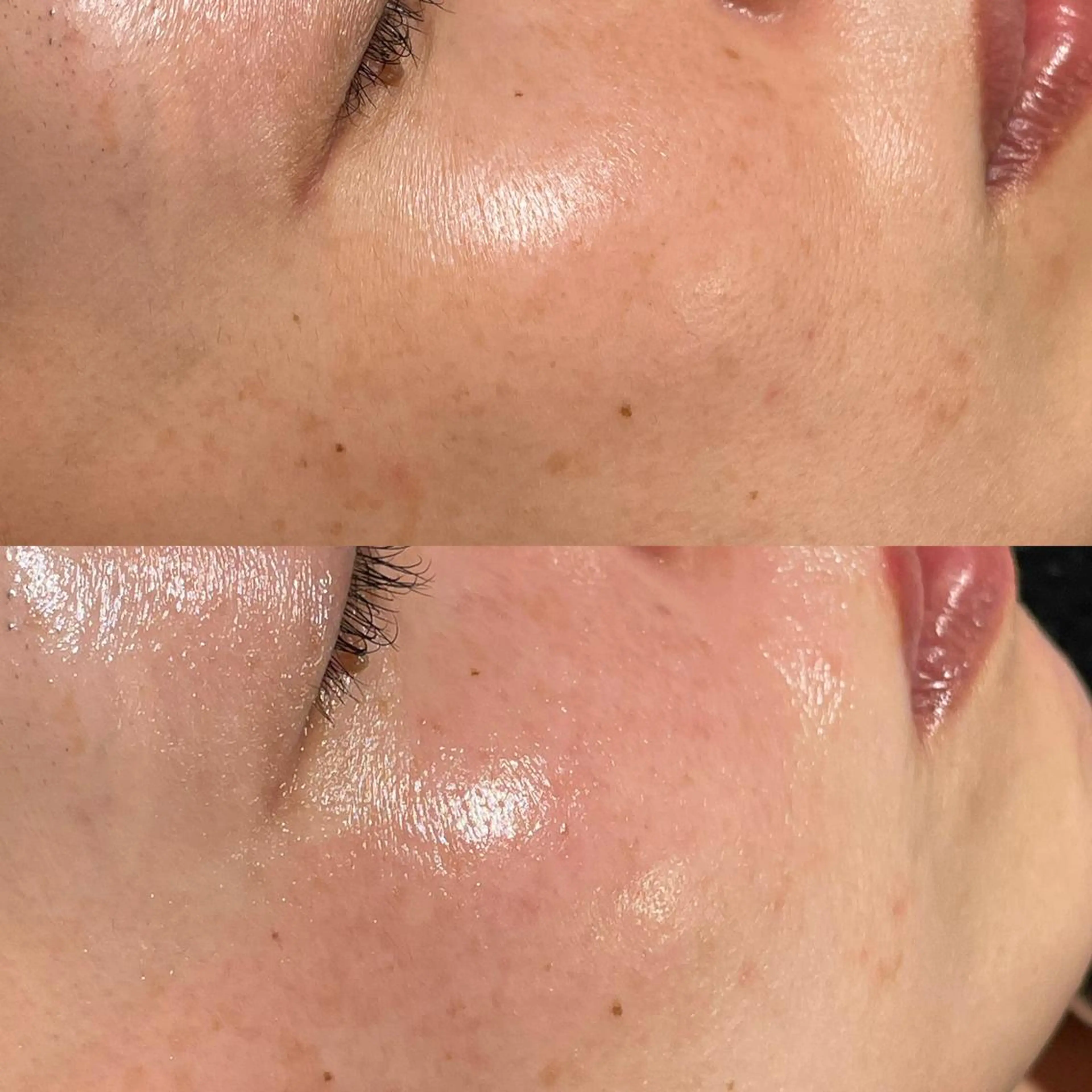 ララピール　近赤外線LEDコラーゲン付き✨の写真