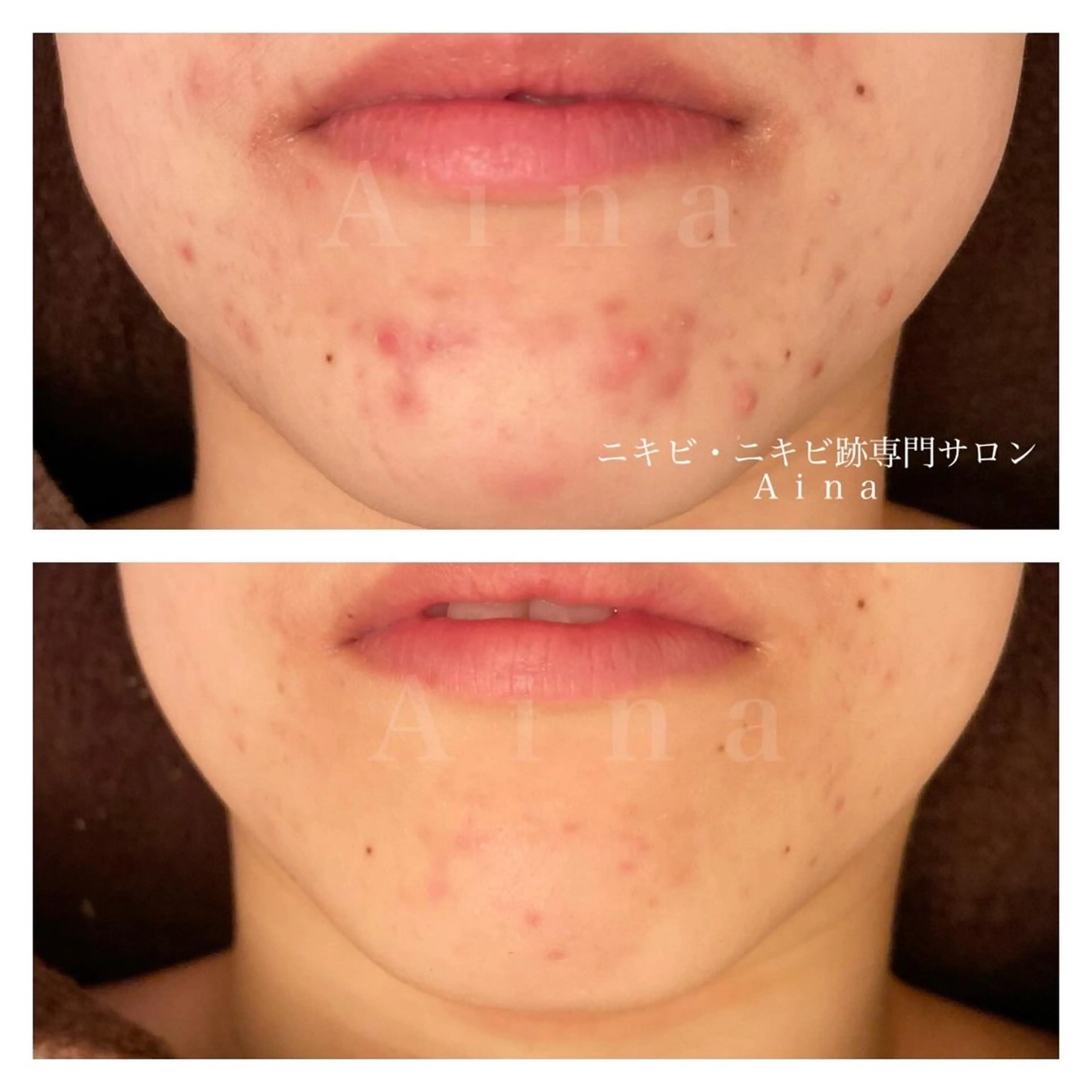 エステ リラク ニキビ跡専門サロン Ainaのエステ・リラクイメージ