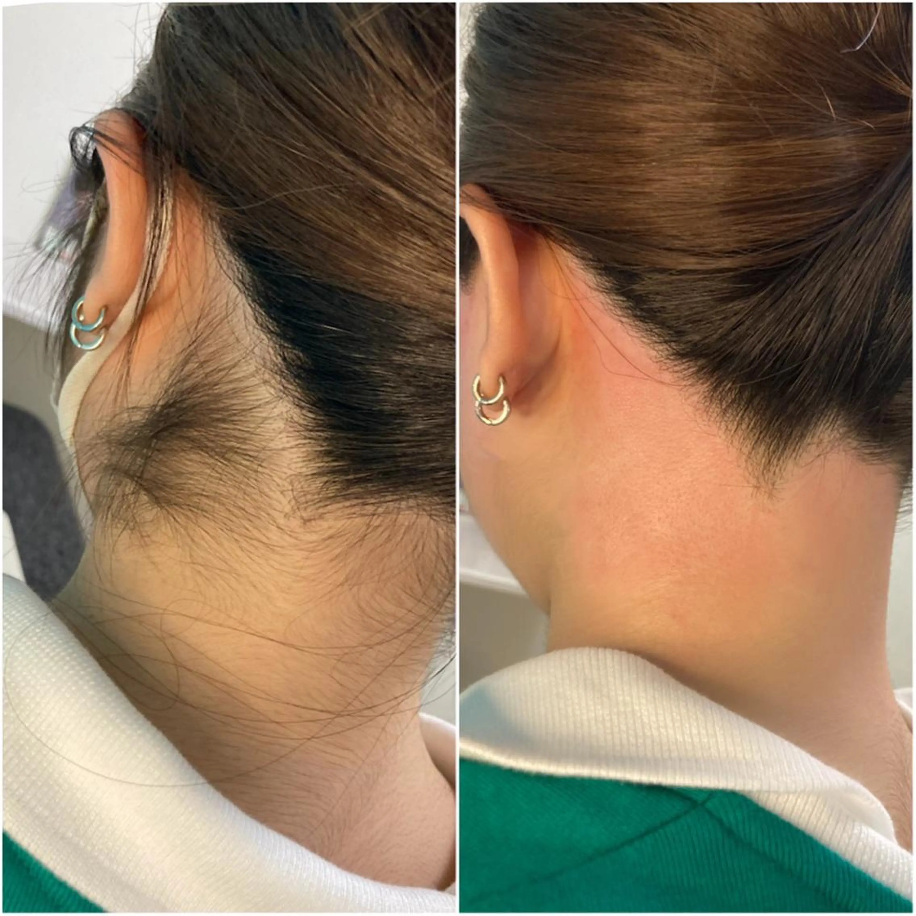 うなじワックス✨髪を結んだ時に気になるうなじをワックス脱毛で綺麗に🫰🏻💗の写真