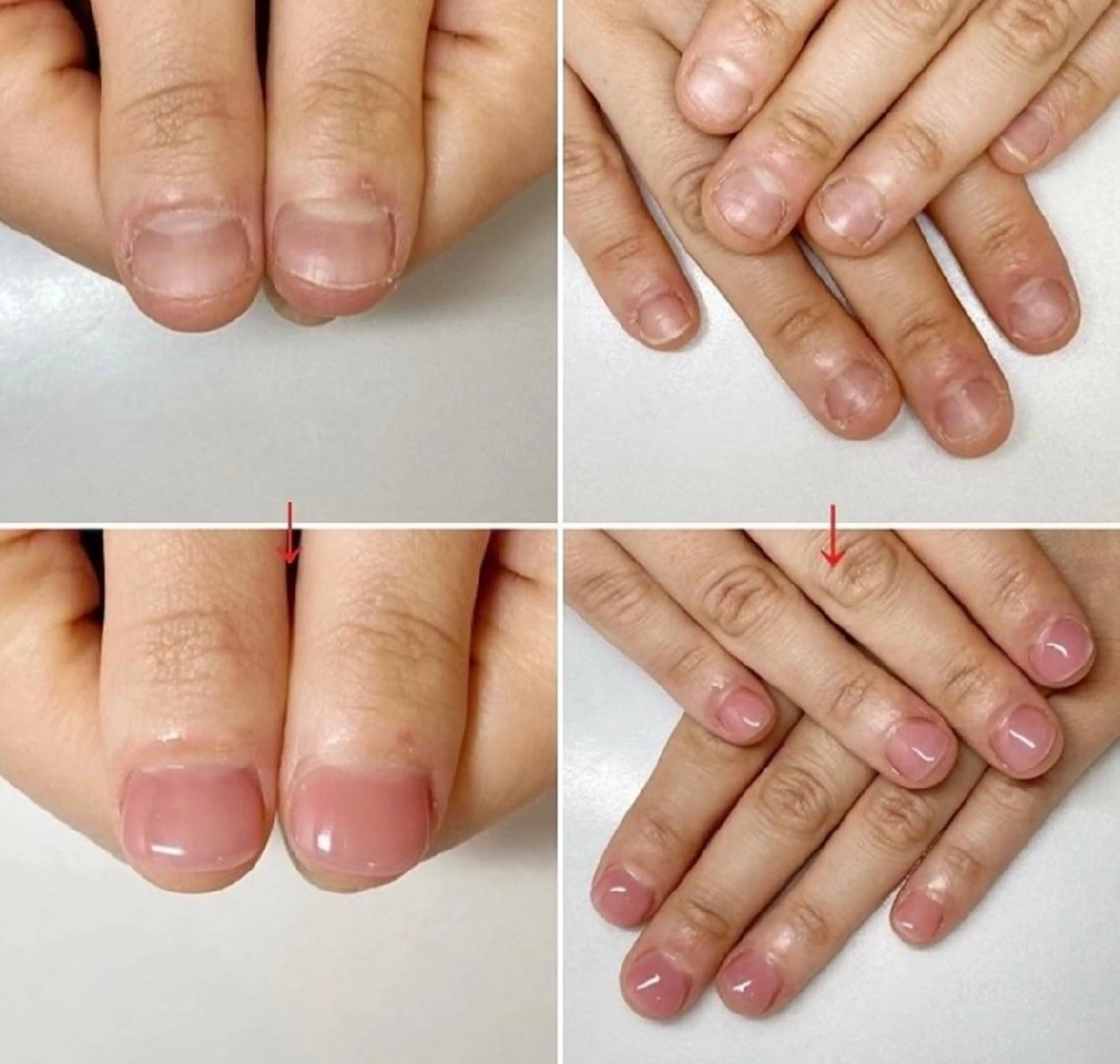 ミニモ限定【深爪・自爪コンプレックス💅】深爪矯正長さ出し10本＋ワンカラーの写真