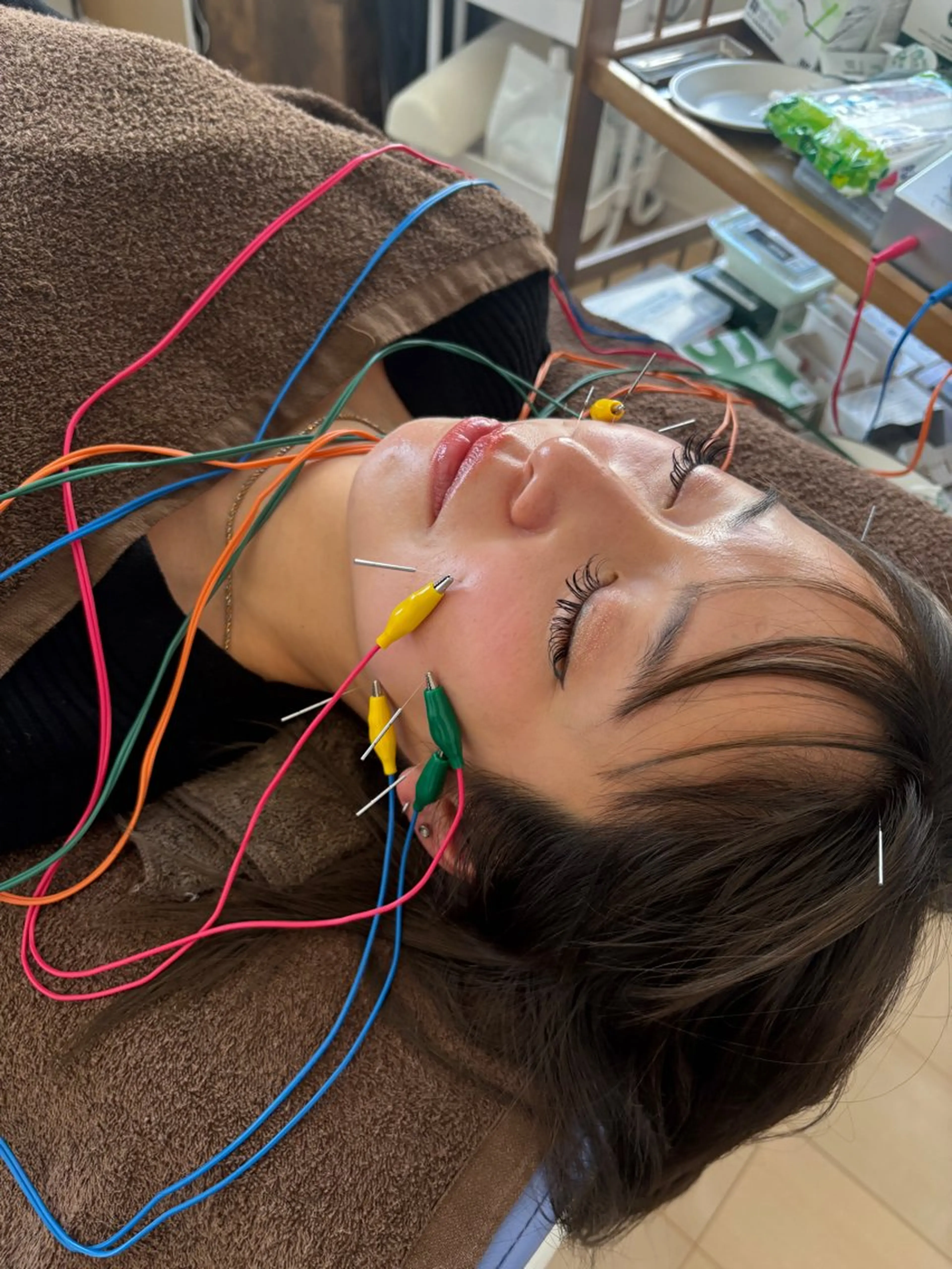 即実感✨小顔×リフトアップ美容鍼5回コースの写真