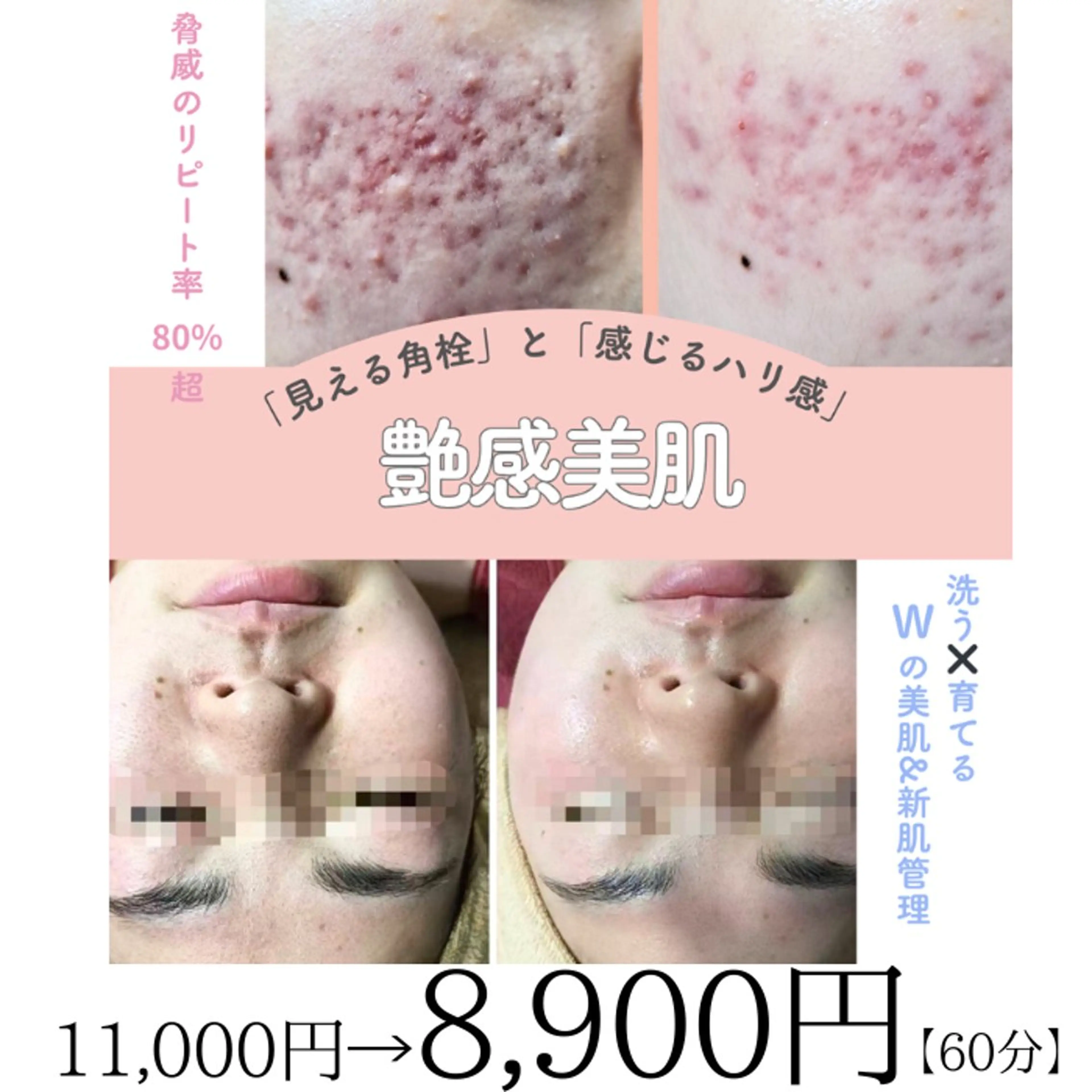 毛穴消滅×劇的小顔ケア｜最新esV10を地域最安級で！【韓国式大掃除】の写真