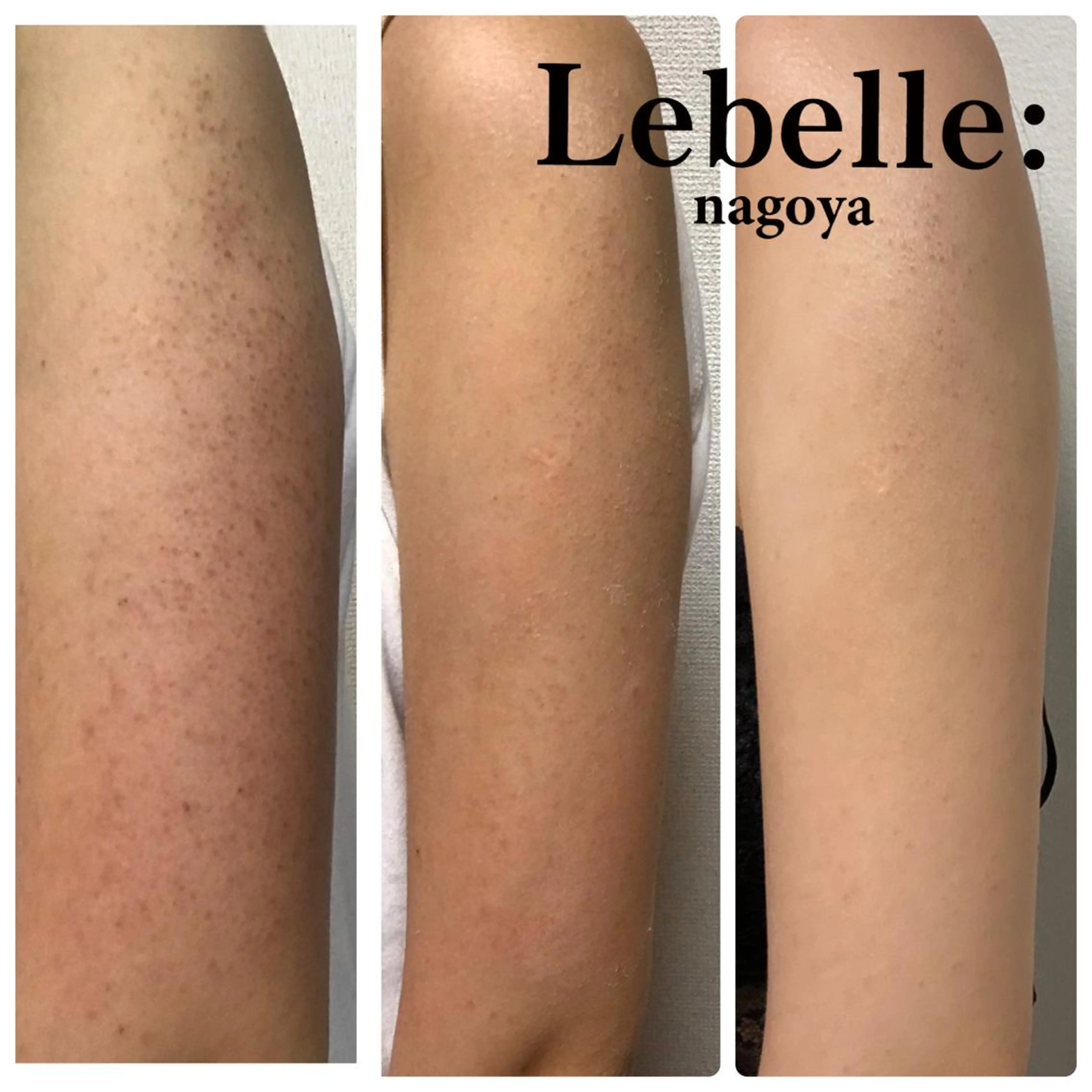 腕の毛孔性苔癬(ぶつぶつ)のハーブピーリング【ラージサイズ】の写真