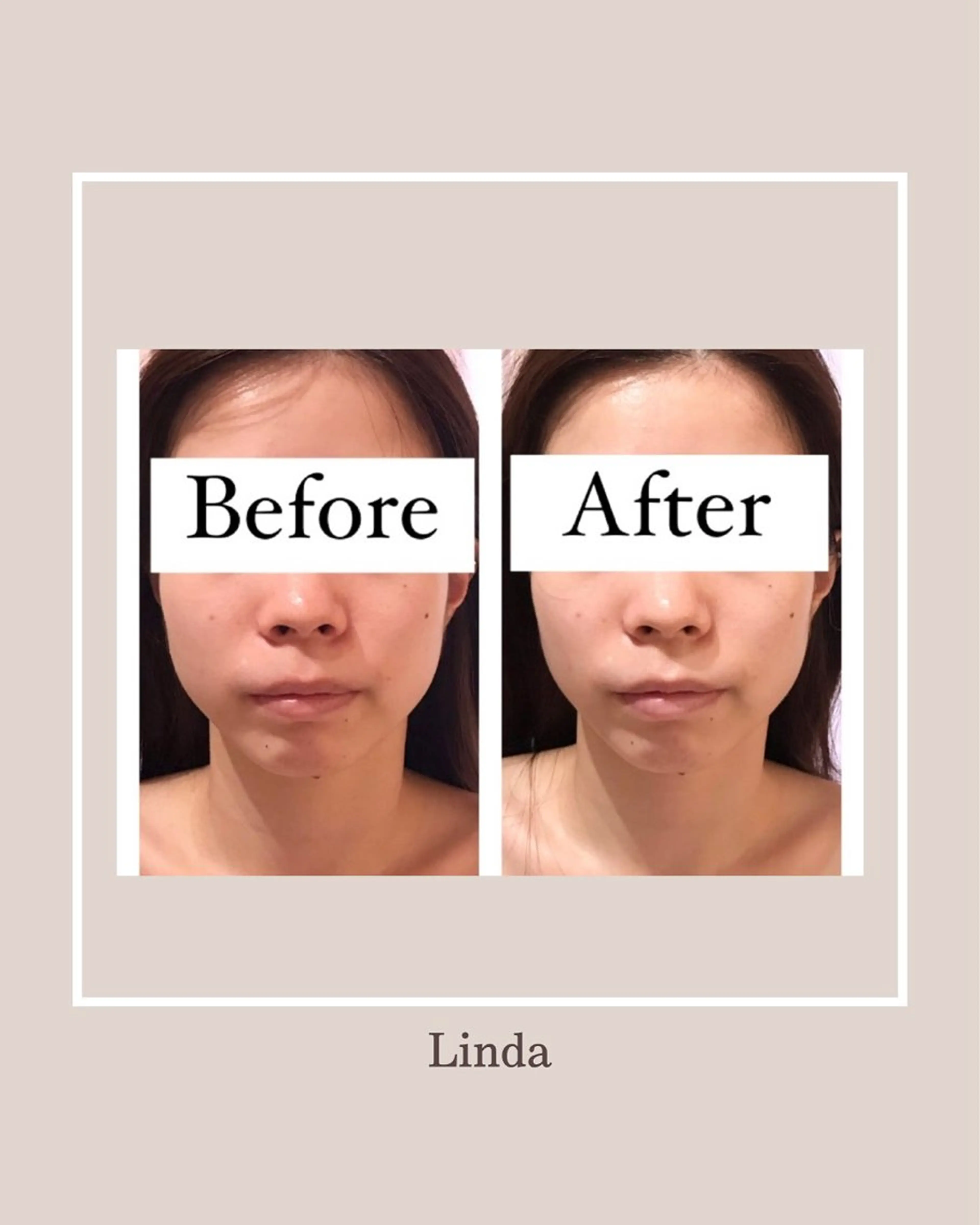 エステ 小顔&毛穴・肌質改善 LINDA西宮 AIのエステ・リラクイメージ