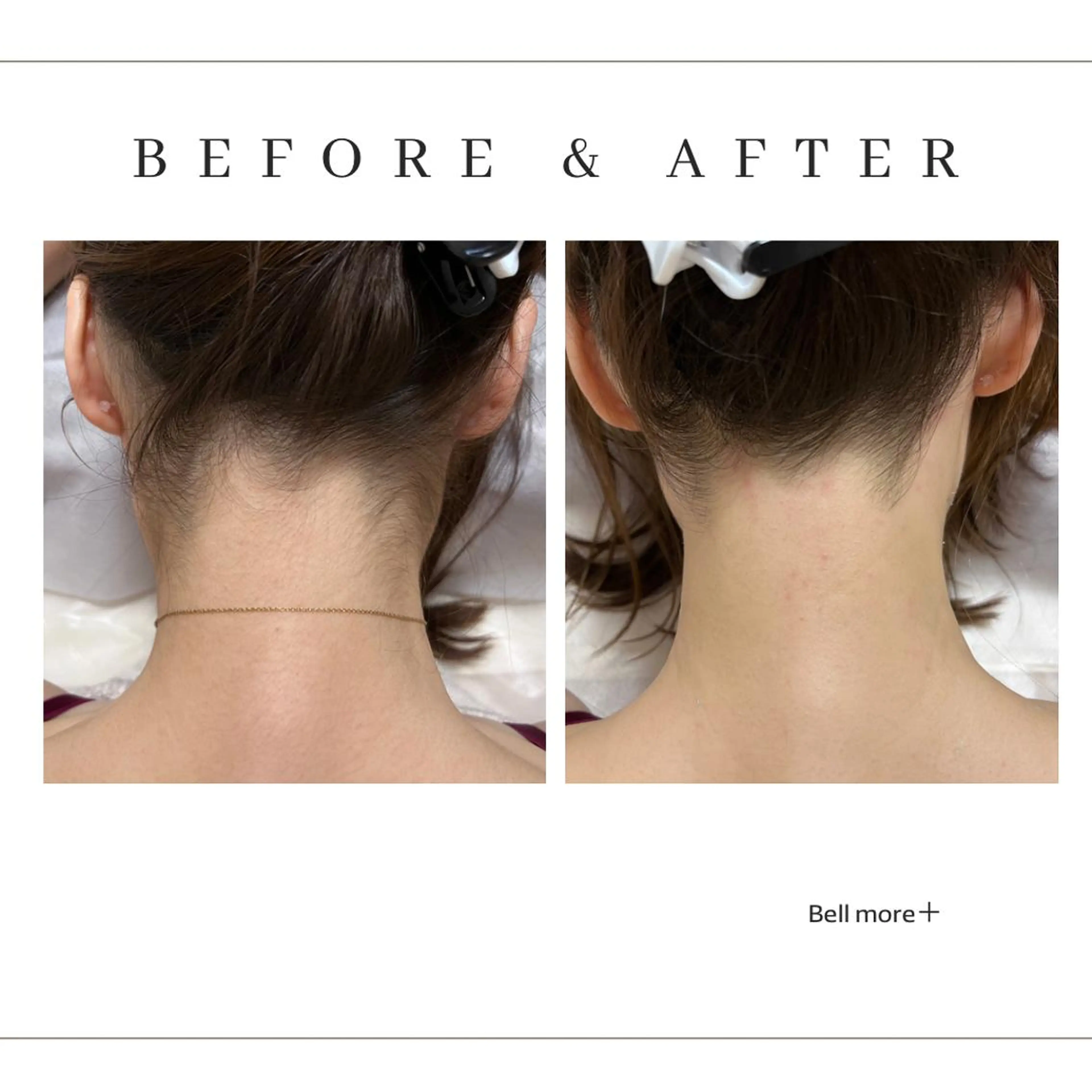 うなじ脱毛の写真