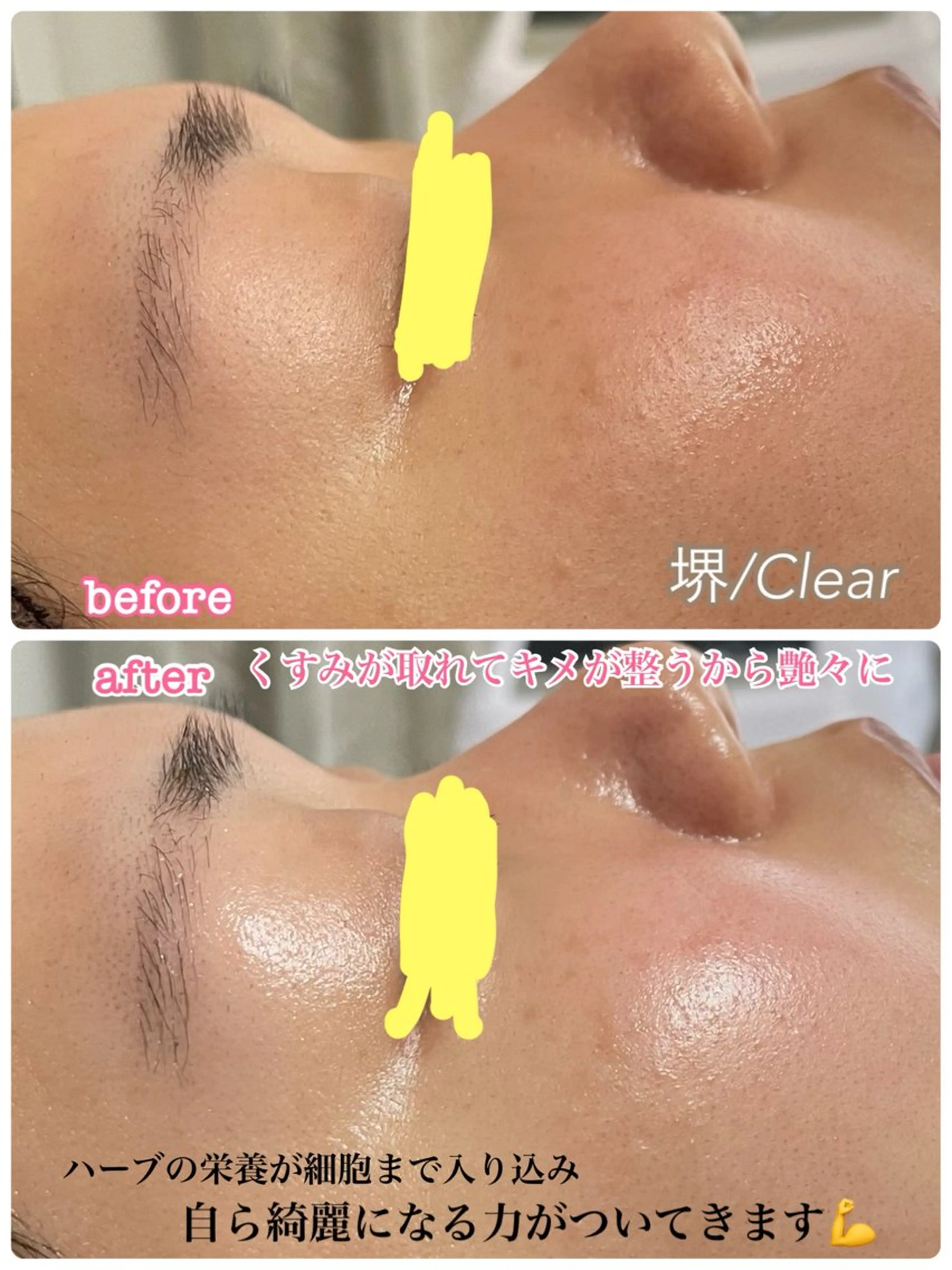 【4月限定】ハーブピーリング🌿透明感・ハリ・毛穴ケアが叶う超お得な美肌オプション付luxuryコース80分🌿の写真