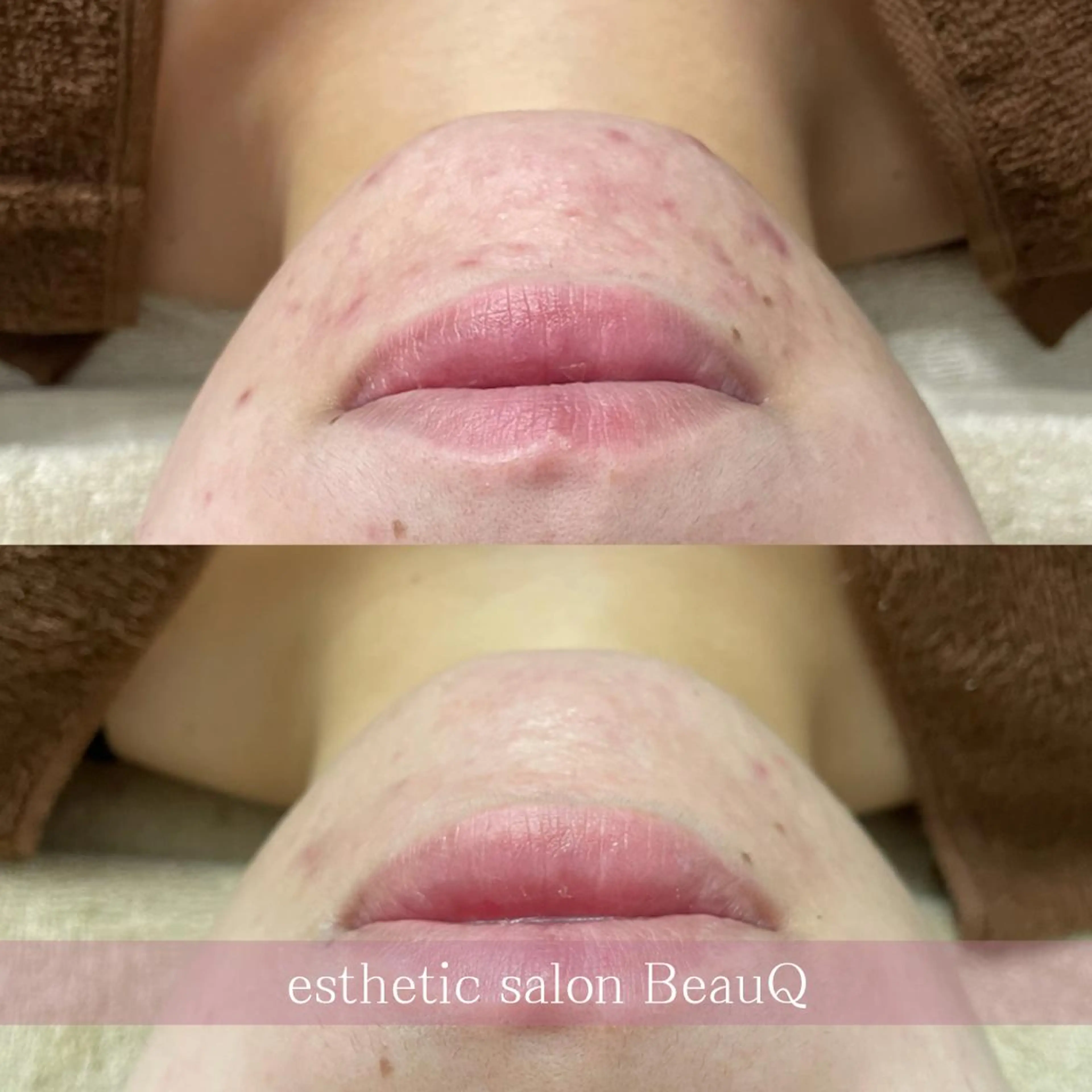 肌質改善/ブライダル 水上百華のエステ・リラクイメージ