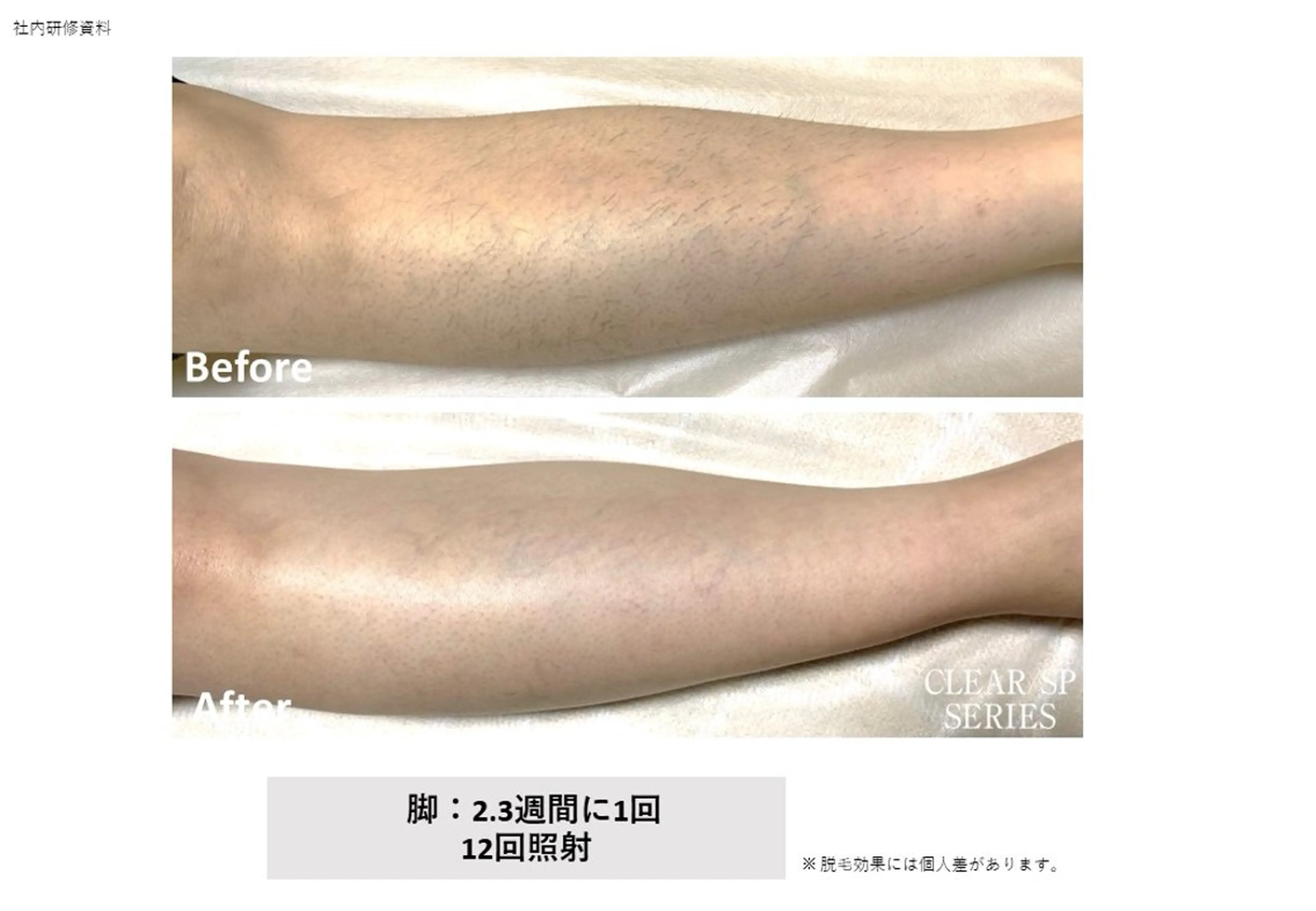 脱毛 野口 茂宰のヘアスタイル