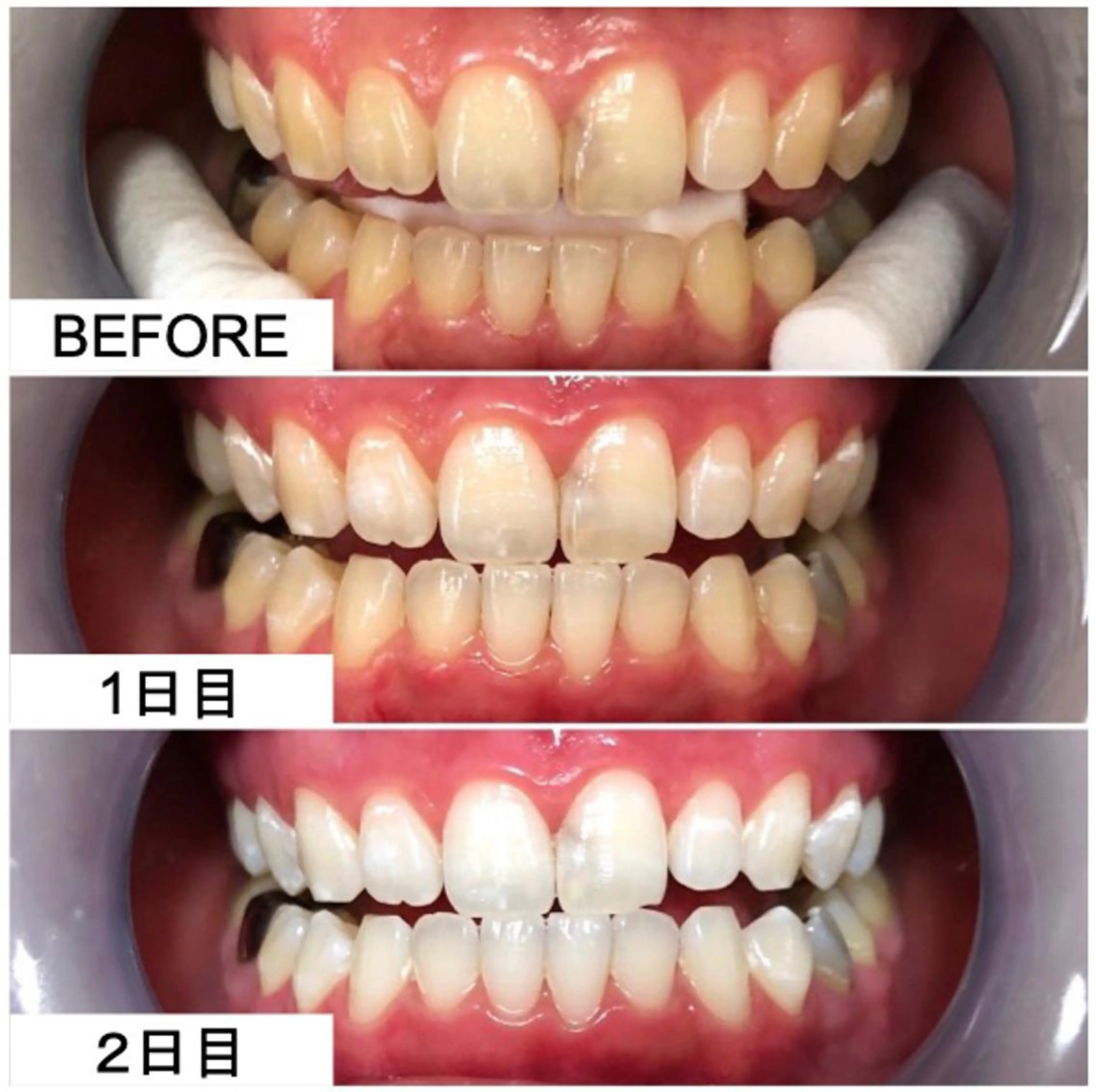 【満足度No.1 】プレミアムコース ​〜​短期間で集中的に。美しく上品な白さへ。​〜​2来店 計115分×9回照射の写真