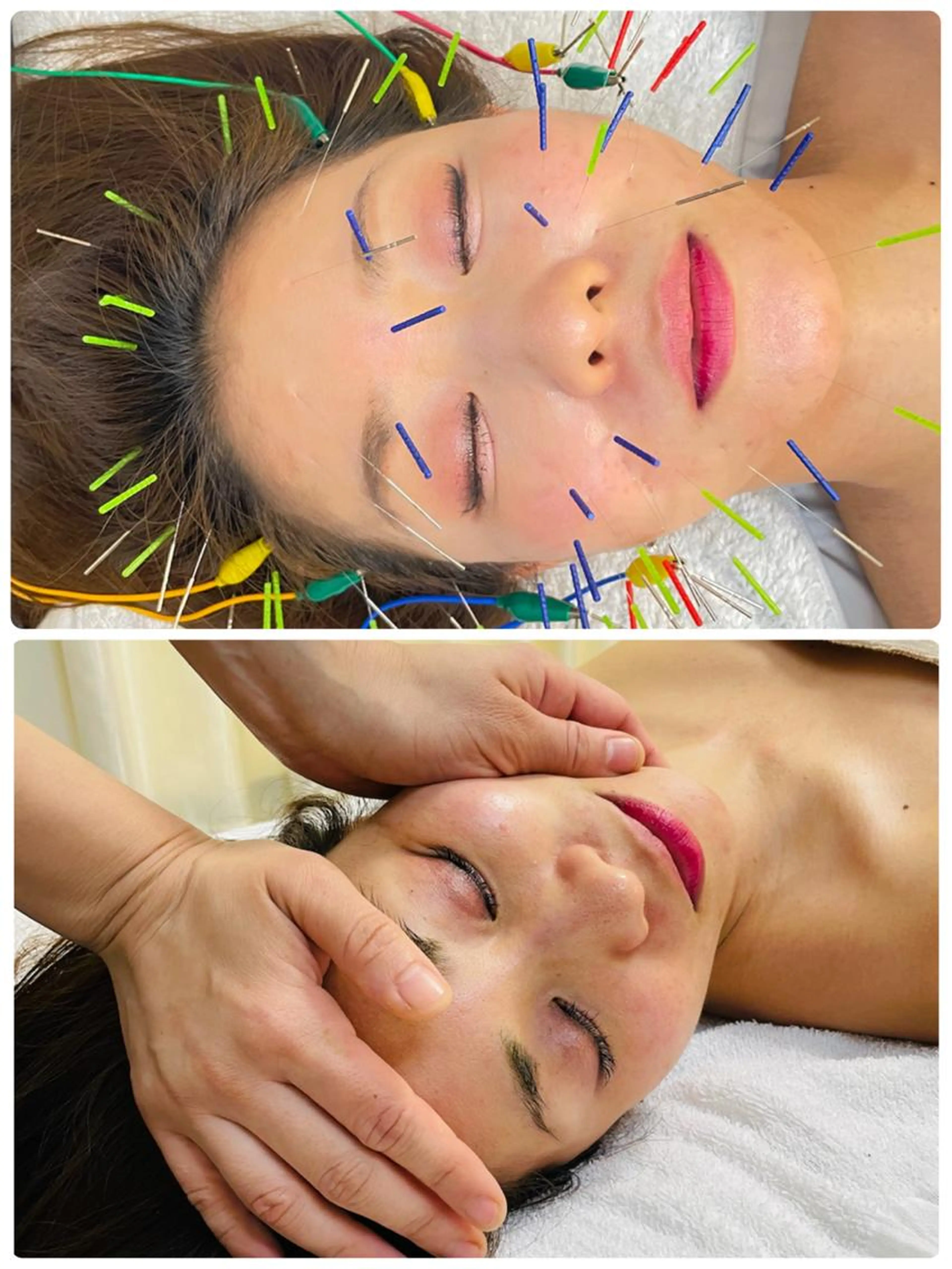 リピーター様✨【3Dリフト美容鍼✖️アロマオイル小顔調整マッサージ】(首肩背中、デコルテアロマオイル+ヘッドマッサージ)の写真