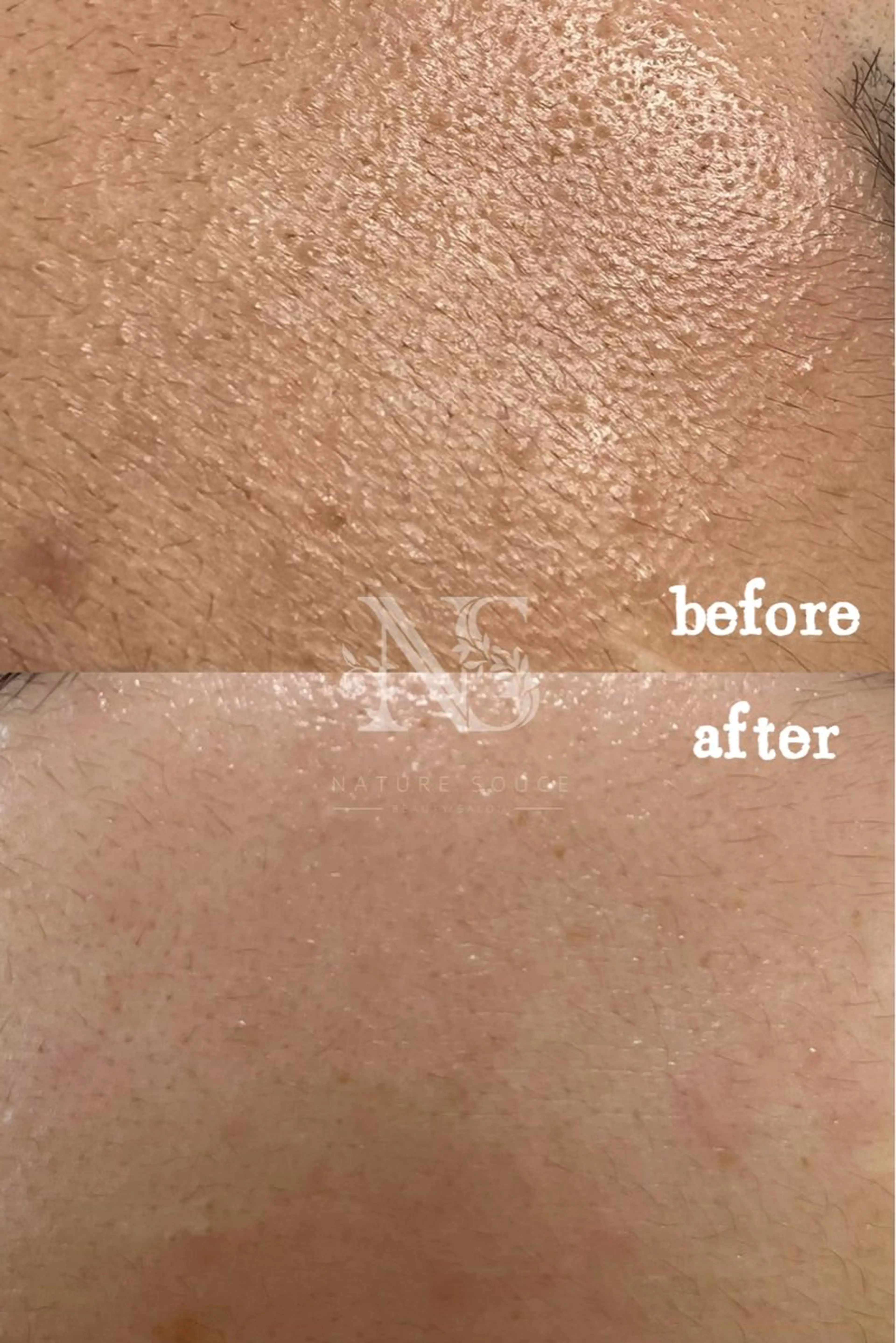 【人気No.1】【毛穴・肌質改善】肌管理フェイシャル◎80分　¥10560（税込）の写真