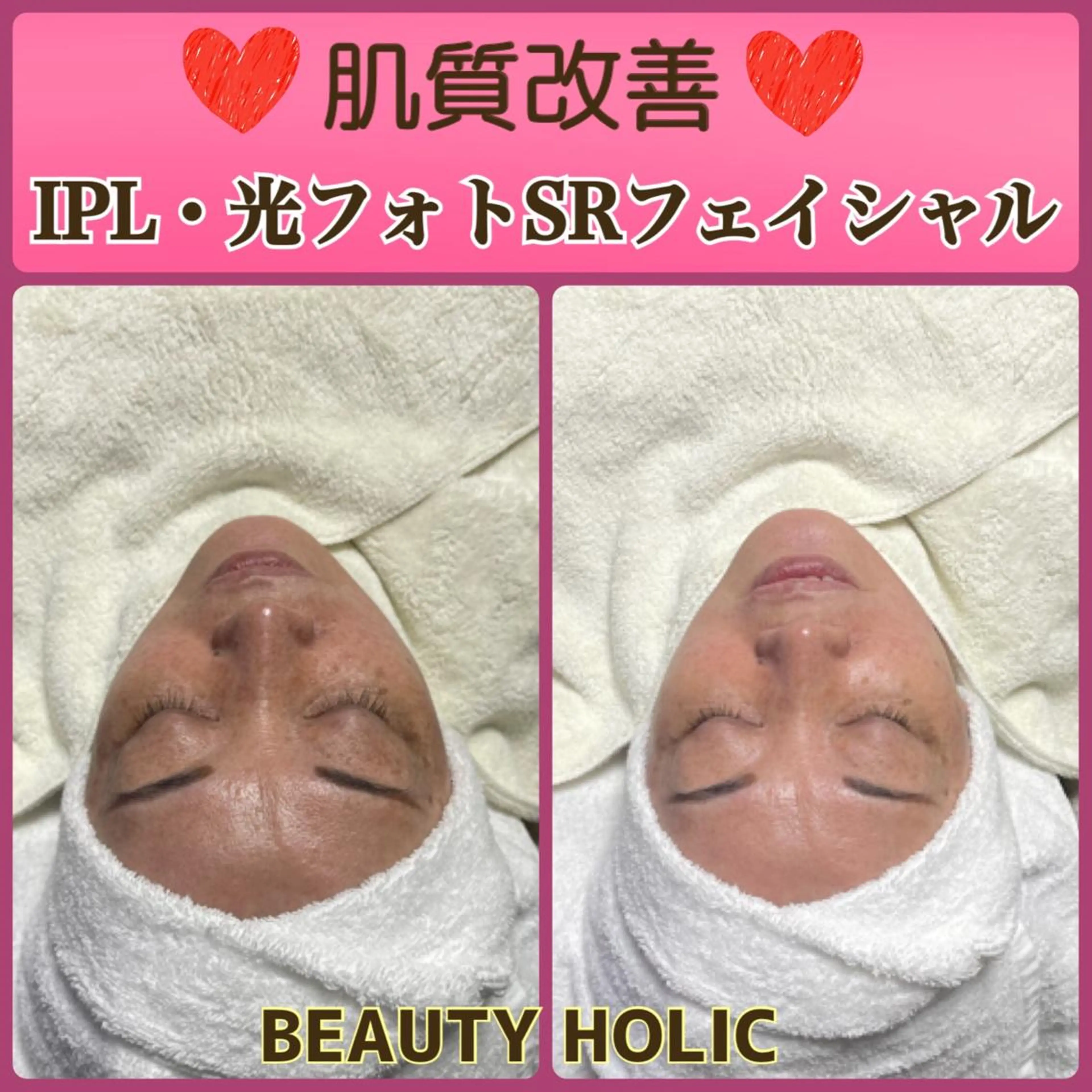 IPL・光フォトSRフェイシャル💓徹底肌質改善💓毛穴の開き・たるみ・シワ・くすみ・ニキビ跡・赤ら顔の写真
