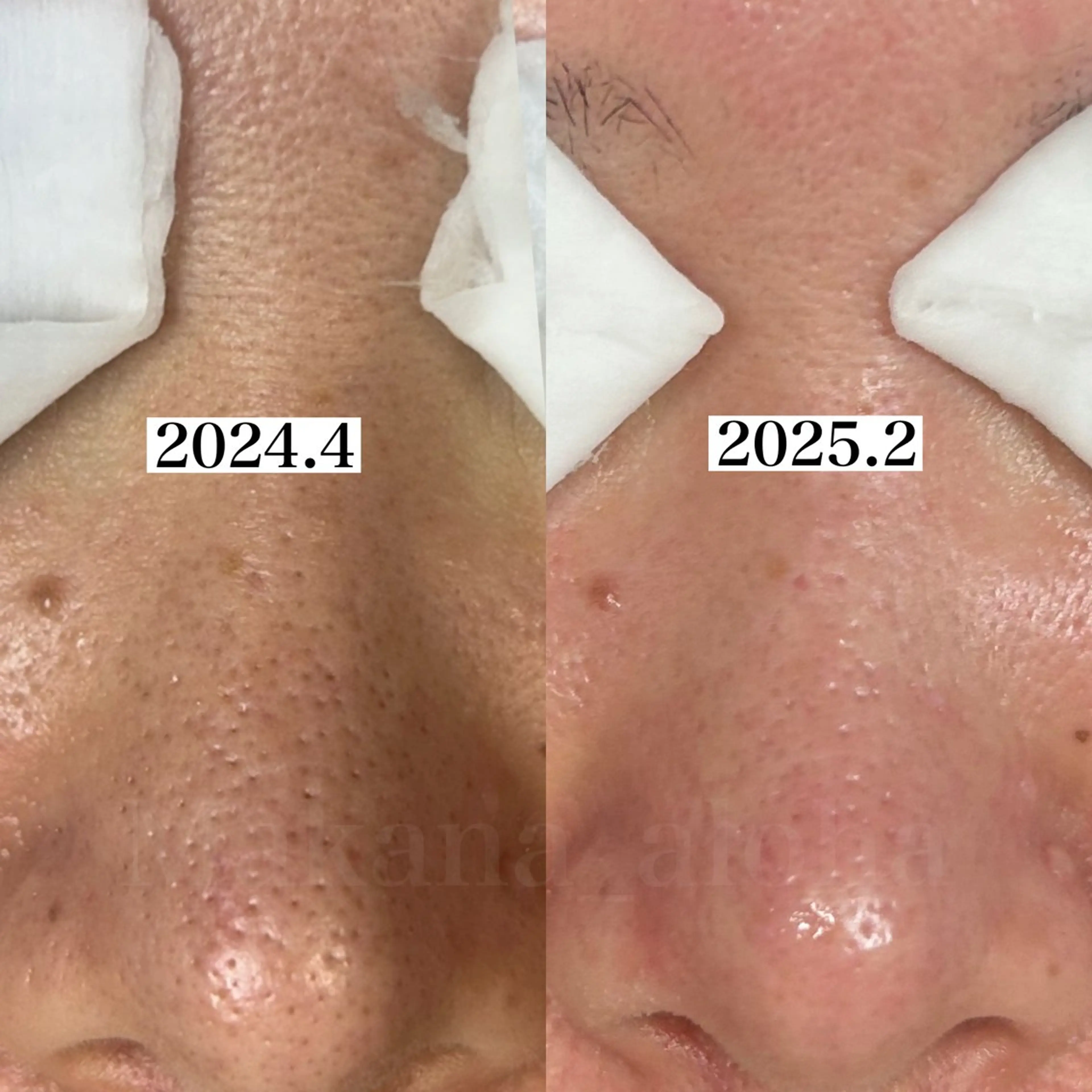 毛穴専門店 マカナアロハのエステ・リラクイメージ