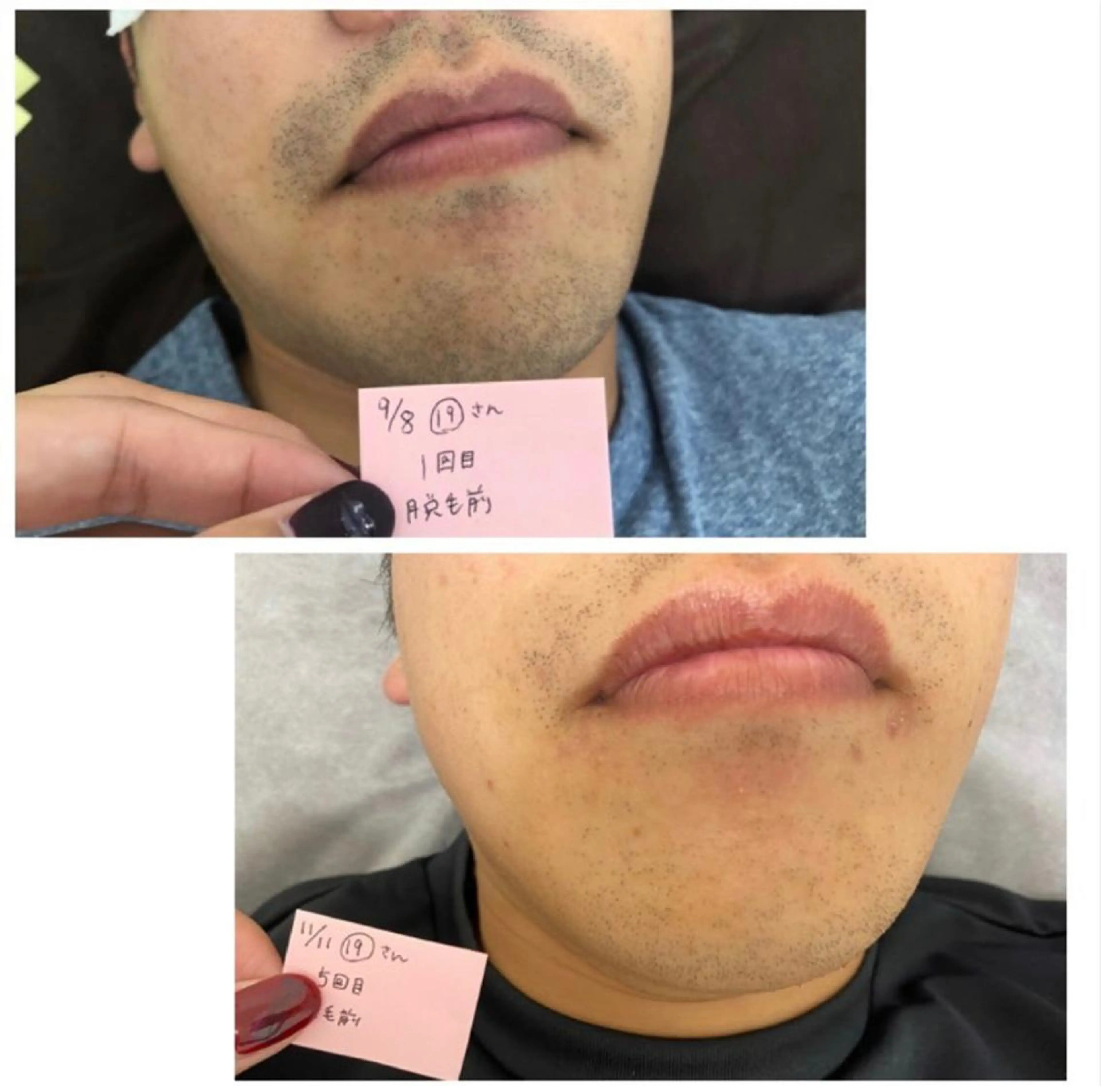 新規メンズひげ脱毛の写真