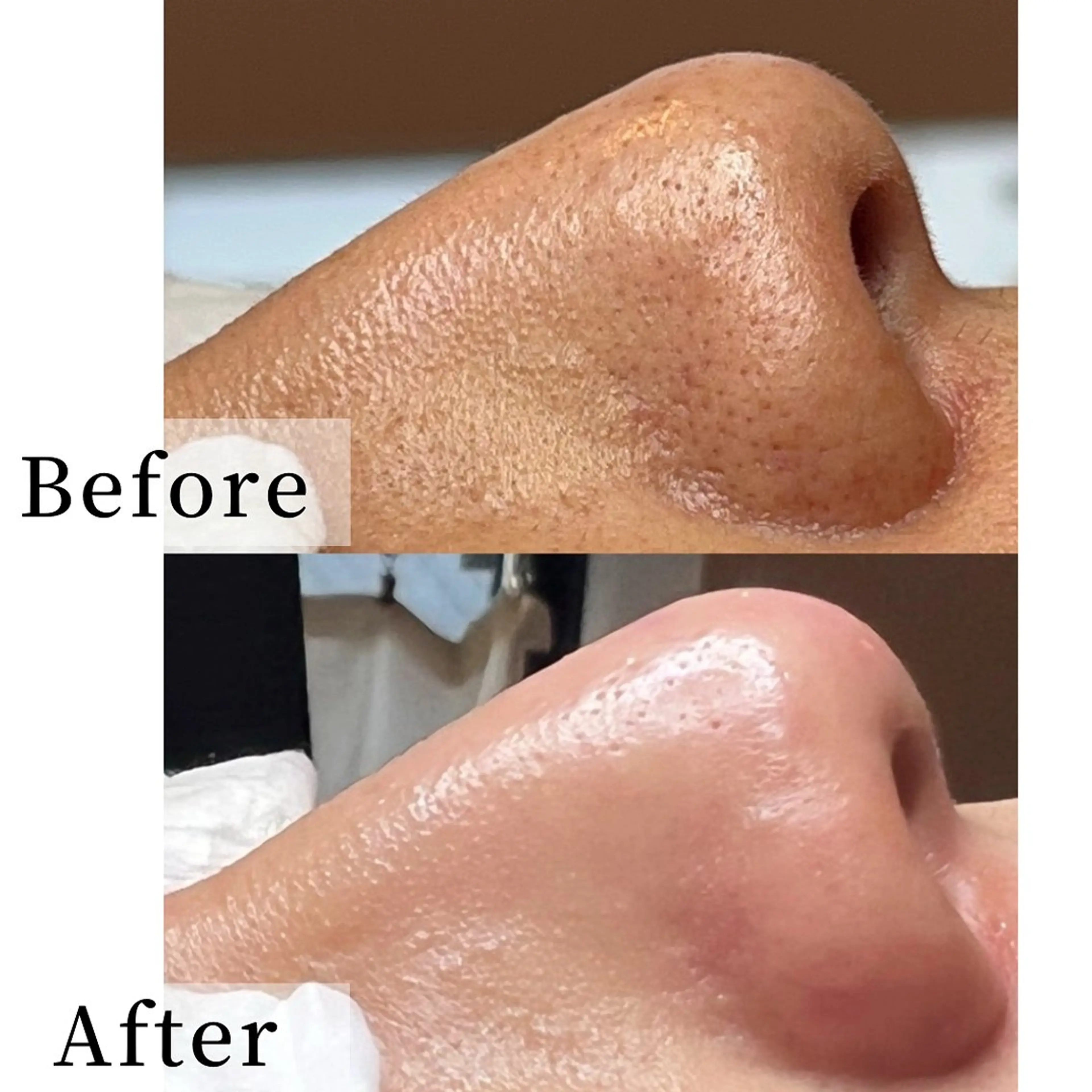 【毛穴ケア】満足度No.1★黒ずみ角栓除去+プレミアム美容液＆マスク付き100分の写真